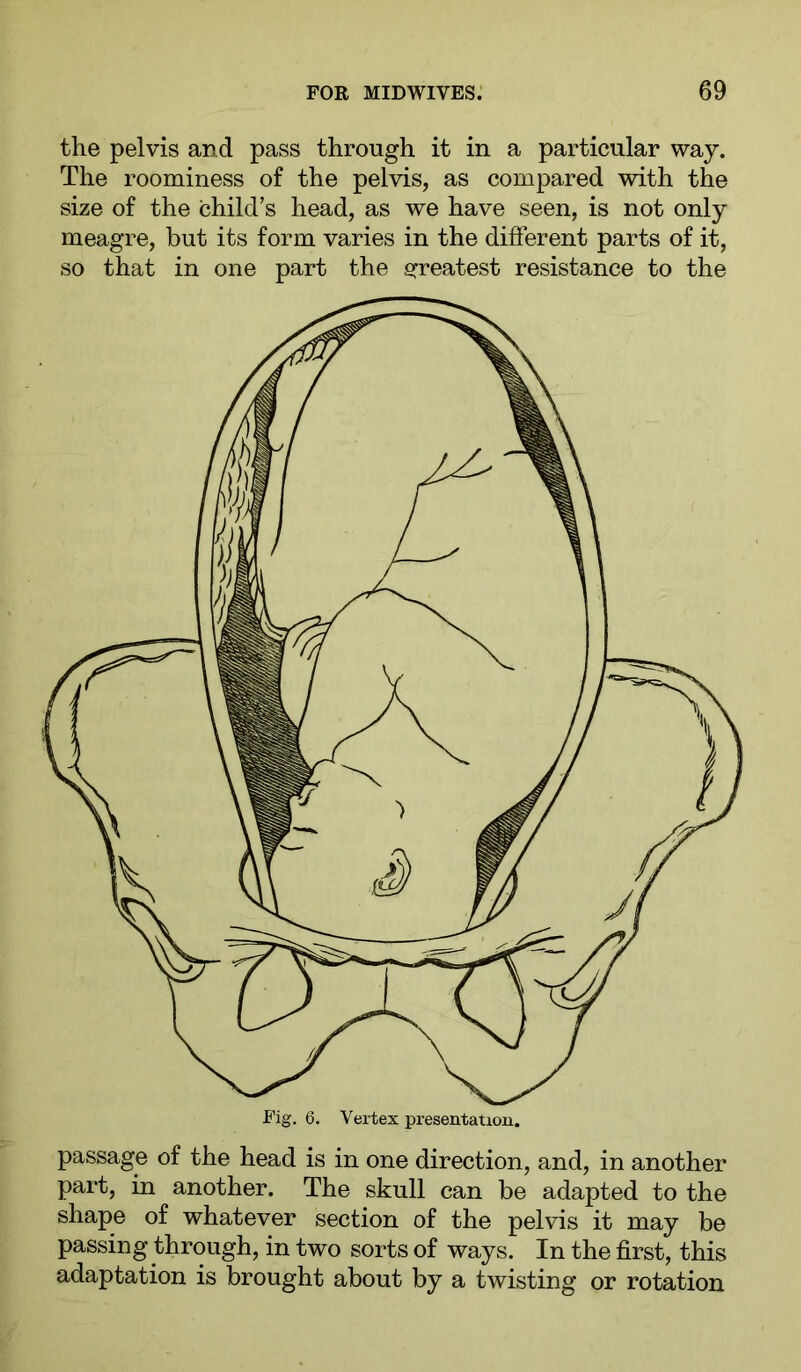 the pelvis and pass through it in a particular way. The roominess of the pelvis, as compared with the size of the child’s head, as we have seen, is not only meagre, but its form varies in the different parts of it, so that in one part the srreatest resistance to the Fig. 6. Vertex presentation. passage of the head is in one direction, and, in another part, in another. The skull can be adapted to the shape of whatever section of the pelvis it may be passing through, in two sorts of ways. In the first, this adaptation is brought about by a twisting or rotation