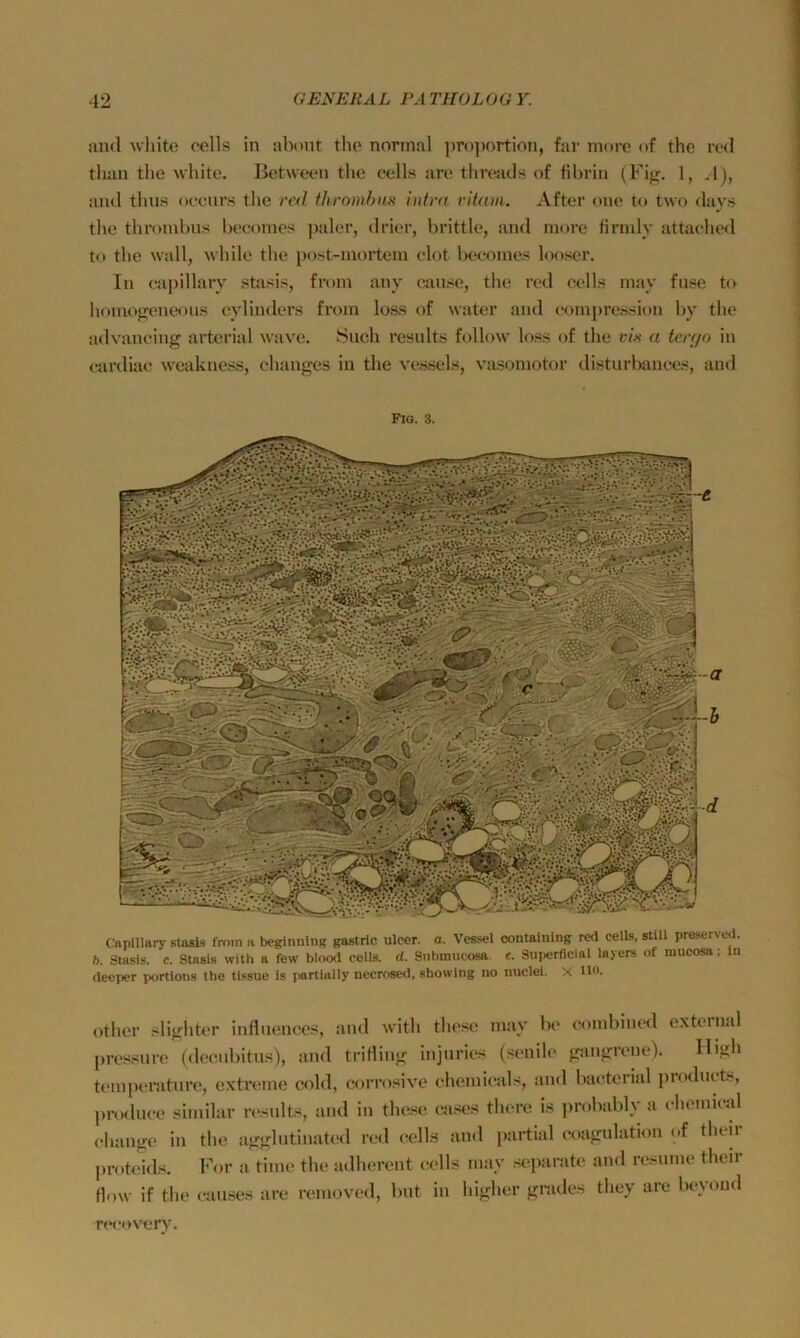 and white colls in abmit tho normal ])ro])ortion, far more nf the red tlian the white, ßetween the cells are thrends of hhrin (Fijr. 1, J), aml thus oeeiirs the red fhromhus i>dr(( ritwii. After one tu two days tlie thromhns beeonics ])aler, drier, hrittle, and more firmly attaelied to the wall, while the i)ost-mortem clot heeoines looser. In eaj)illarv stasis, froin any eiuise, tlie red eells may fiir>e to homofjeneou.s eylInders from loss of water and eompression hy tlie a<lvaneing arterial wave. Such results follow loss of the f/.s a teiyo in eardiae weakness, chauges in the vessels, vasomotor disturhanees, and Fig. 3. (leeper portions the tlssue is partially necrosed, phowlng iio nuclei. X Uh. otlicr slighter inflnenees, ;ind with these in:iy he eomhiniKl extein.d [tressure (deeuhitus), tind tritling injnries (senile gangrene). High temperature, extreme cold, corrosive ehemietds, and haeterial [troduct., prodnee similar rt'sults, and in these enses th(‘re is jirolnddy a ehoinieal (•hange in the agghitinated red eells and partial eoagnlation of theii proteids. Imu- a time the iidhercnt eells may sejtariite and nisume their flow if the eauses are removed, hut in higher gnides they are heyoud recovery.