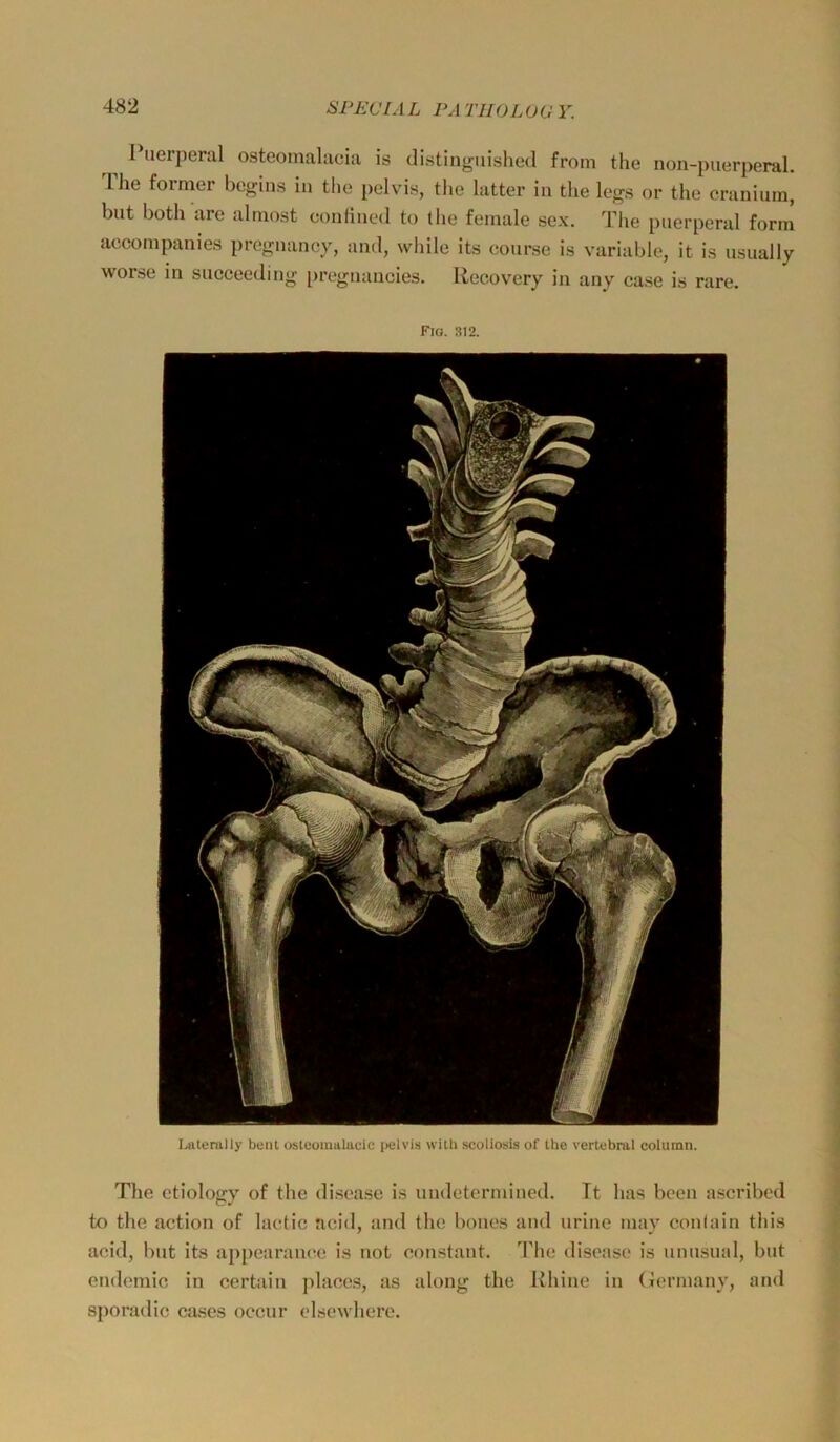 Puerperal osteomalacia is distinguished froin tlie non-puerperal. Ihe former begins in the pelvis, the latter in tlie legs or the craniuin, but both are alniost conlined to the feniale sex. The puerperal form accompanies pregnaney, and, while its eourse is variable, it is usually worse in succeeding i)regnancies. Recovery in any case is rare. Fig. 312. Lrtterully bunt osteoraalucic pulvis with scoliosis of the vertebral column. The etiology of tlie disease is undetermined. Tt has been ascribcd to the aetion of lactic acid, and the bones and uriiie may conlain tliis acid, but its appearauee is not eoustant. The disease is unusual, but endemio in certain jilaees, as along the Rliine in (jermany, and sjioradic cases occur elsewherc.