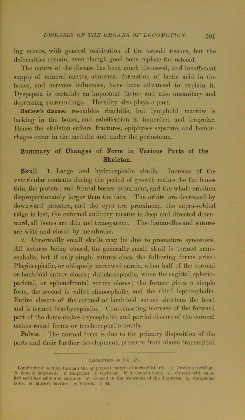 ÖOl ing occnrs, with gonoral ossilicution of tlie osteoid tissues, hut the deformlties remain, even though good lione roplace the osteoid. The nature of the disease has been much diseiissed, and insuflieient supply of mineral matter, abnormal formation of laetie aeid in the bones, and nervous intluences, have beeu advanciod to explain it. Dvspepsia is certainly an important faetor and also unsanitary and depressmg surroundings. 1 leredity also plays a part. Barlow’s disease resembles rhachitis, but lymphoid marrow is lacking in the bones, and calciücatiou is iinperfect and irregidar. rience the skeleton suffers fracturcs, epiphyses separate, and hemor- rhages oecur in the medulla and ander the periosteuin. Summary of Changes of Form in Various Parts of the Skeleton. Skull. 1. Large and hydrocephalic skulls. increase of the ventricular contents during the period of growth makes the flat bones thin, the parietid and frontal bosses prominent, and the whole cranium disproi>ortionately larger than the face. The orbits are decreased by down ward pressure, and the eyes are prominent, the supra-orbitiil ridge is lost, the external auditory meatus is deep and directed down- ward, all bones are thin and transparent. The fontanelies and sutures are wide and closed by membrane. 2. Abnormally small skulls may be due to premature synostosis. All sutures being closed, the generally .small skull is termed nano- cephalia, but if only single sutures close the following forras arise: F^lagiocephalic, or obliquely narrowed crania, when half of the coroual or lambdoid suture closes ; dolichocephalic, when the sagittal, spheno- parietal, or sphenofrontal suture closes; the former gives a simple form, the second is called cliuocephalic, and the third leptocephalic. Entire closure of the coronal or lambdoid sutim; shortens the head and is termed brachycephalic. (Jornpensatiiig inerease of the forward part of the dorne makes oxycephalie, and partial closure of the coronal makes round forms or tro(’hoe.ephalic crania. Pelvis. The normal form is due to the ])rimary <lisposition of the parts and their further development, pressure from above transmittcd Desckiptioji of Kio. S26. lyinprUndinRl »eption thro'.igh the eplphyseal rniirRin of r rhachitic rib. A Orowltiff cartUnge. B. Zone of large cells C. DlaphyslR. k. CiutUflKC. fc*. o. Osteoid tissue. o'. Osteoid with calci- fied oartÜRKe cells and cu|isulc8 o*. Osteoid ln the trabeculie of the dinpliysls. ki. Completed hone. m. Marrow cavities. g. Vesscls. X 30.