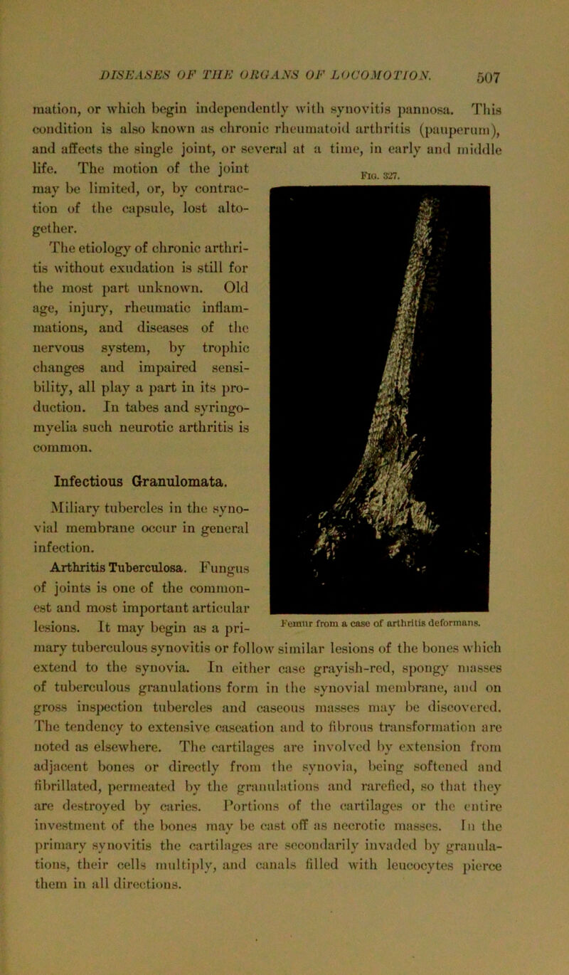 ination, or whicli bcgin indepeiulently with synovitis ])annosa. Thls condition is also kuown as chronic rheumatoid artiiritis (pauperuni), and affects the single joint, or several at a time, in early und middle life. The motion of the joint may be limited, or, by contrae- tion of the capsule, lost alto- gether. The etiology of chronic arthri- tis without exudation is still for the most part unknown. Old age, injurj', rheumatic intlam- mations, and diseases of the nervous System, by trophic and impaired sensi- bility, all play a part in its pro- duction. In tabes and syringo- myelia such neurotic arthritis is common. Infectious Granulomata. Miliary tubercles in the syno- vial membrane occur in general infection. Arthritis Tuberculosa. Fungus of joints is one of the common- est and most important articular lesions. It may begin as a pri- mary tuberculous synovitis or follow similar lesions of the bonos which extcnd to the synovia. In either case grayish-red, spongy masses of tuberculous granulations form in the synovial membrane, and on gross ins])eetion tubercles and caseous masses may be discovered. 'Phe tondency to extensive caseation and to lilirous transformation are noted as elscwhere. The eartilages are involved by extension from adjacent bones or directly from the synovia, being softoned and fibrillated, permeated by the granulations and raretied, so that they are destroyed by caries. Portions of the <;artilages or th(> entiro invostment of the bones may be east off as necrotic masses. In the primary synovitis the eartilages are secondarily invaded by grannla- tions, their cells multiply, and canals lilled with leueocytes ])ierce them in all directions.