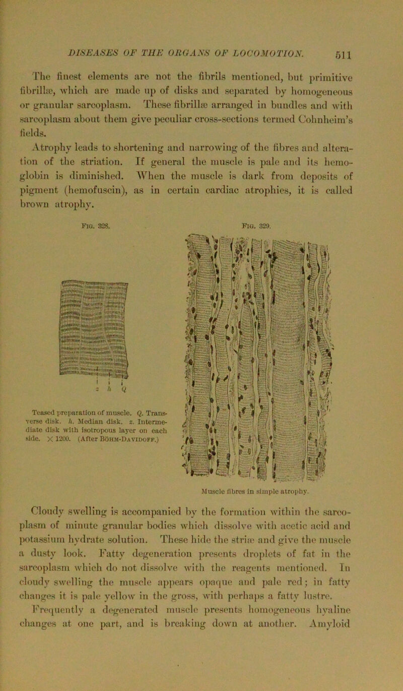 DISEASL'S OF THE OIi(Ei.\E OF LOCOMOTLON. Öll riie ünost elemeiits uro not the fibrils mentioned, hut j)rimitivc librilhc, M’hich ure nmclo iip of disks and sej)arated by lioinogeneous or granulär sarcoplasin. These fibrilhe arranged in bundlos and witb siireoplasm about theni give peculiar cross-sections terined Cohnheiin’s tields. Atropby Icads to shortening and narrowing of the libres and altera- tion of the striatlon, If general the niusele is ])ale and its hemo- globin is diminished. When the nuisele is dark froin deposits of pignient (hemofuscin), as in certidu cardiac atrophies, it is called brown atropby. Kig. 328. Teascd prcparation of muscle. Q. Trans- verse disk. h. Median disk. z. Interme- diate disk wllh isotropoua laycr on eacli aide. X 1200. (After Böhm-Davidoff.) Fia. 329. Muscle llbrcs in simple ntropliy. Cloudy swelling i.s accompanied by the fonnation within the .sareo- plasm of ininute gninular bodies which dissolve wlth tiectic ticid and pota.ssium hydrate solution. The.se hide the strite and give the muscle a dusty look. J'^atty degeneration pre.sents droplets of f;it in the sareoplasm which do not dis.solve with the reagtaits intMitioncd. In cloudy swelling the mu.sch* tippoars ojiatiue and jiale red; in fatty ehanges it is ]):de yellow in the gross, with ])erha|)s a fatty Instre. f'retjuently a degenoritted nm.sch' prcsents homogeneons hvtiline ehanges at one part, and is breaking down tit anotlntr. Amyloid