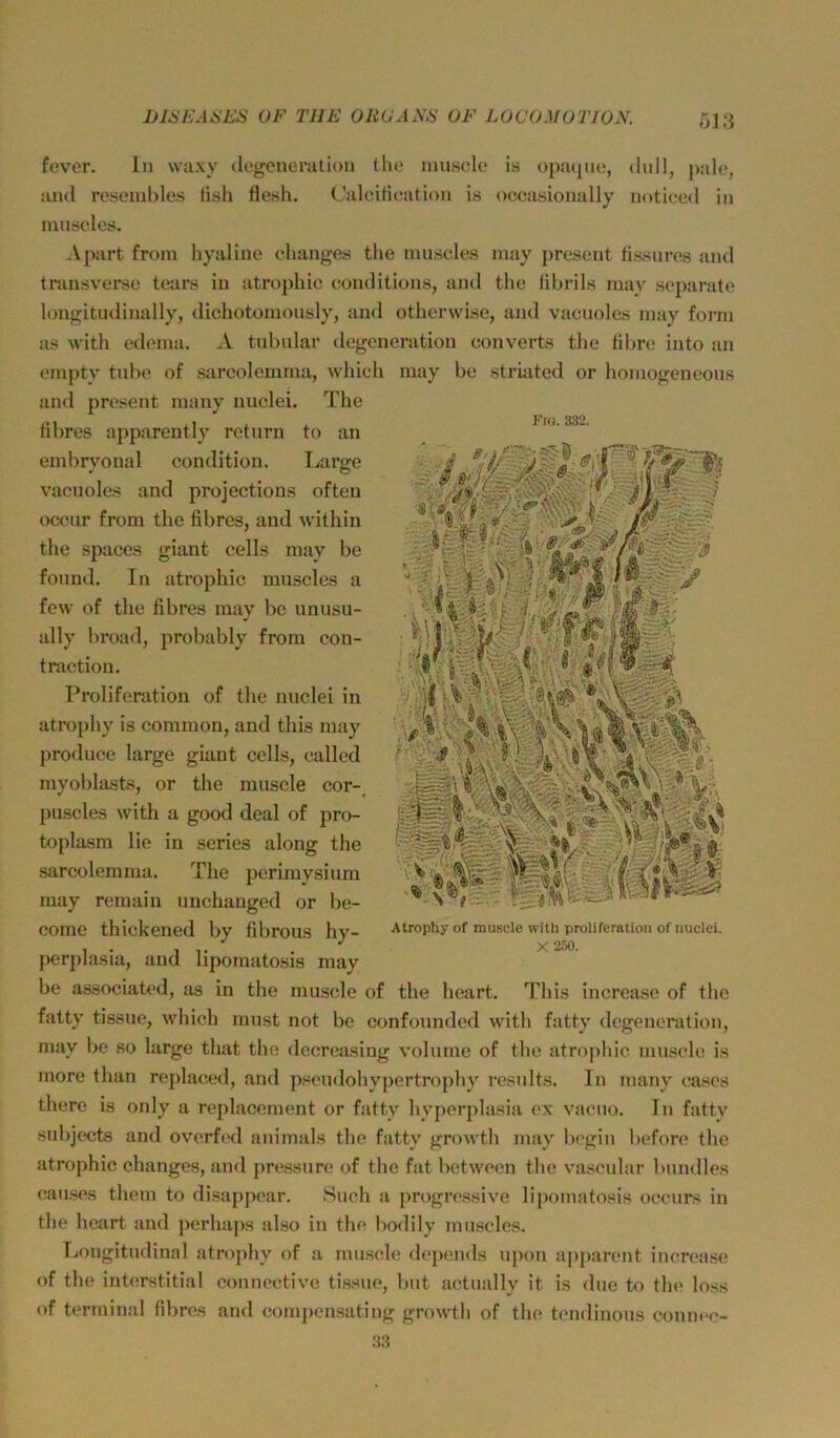 DlillCAüL’S OF TUE OliUAEE OF LOCOMOTION. öl;} Fig. 332. fever. ln wuxy degeueration the inusele is opjujue, dull, pale, and resenibles tisli fle.sh. Calcilicaition is occasionally notieed in museles. .Vpart from liyaline clianges the niuseles may present Hssures und transverse tears in atrophic eonditions, aml tlie fibrils may separate longitudinally, ilichotornously, and otherwise, and vaciioles may form as with edema. A tubulär ilegeneration converts tlie tibre into an empty tube of sarcolemma, whicli may be striated or liomogeneous and present many nuclei. The tibres apparently return to an embryonal condition. Large vacuoles and projections often oceur from the tibres, and within the spaces giant cells may be found. In atrophic muscles a few of the fibres may be unusu- ally broad, probably from con- traction. Proliferation of the nuclei in atrophy is common, and this may produce large giant cclls, called myoblasts, or the mnscle cor-_ puscles with a good deal of pro- toplasm lie in series along the sarcolemma. The perimysium may remain unchanged or be- come thickened by tibrous hy- pcrplasia, and lipomatosis may be associab'd, as in the miiscle of the heart. This increase of the fatty tissue, which must not be confounded with fatty degeueration, may be so large that the decreasing volume of the atrophic mnscle is more than replaced, and p.seudohypertrophy result.s. In many cases there is only a replacement or fatty hyperplasia ex vacuo. ln fatty subjwts and overfed animals the fatty growth may bcgin befon» the atrophic changes, and pn^ssimi of the fat between the vascular bundles cau.ses them to disappear. Such a progi’cssive lipomatosis occurs in the heart and perhaps also in the bodily muscles. Ijongitudinal atrophy of a mnscle depends u{)on apj)arent increase of the interstitial connective tissue, but actually it is <lue to the loss of terminal fibres and compensating growth of the tendinous conncc- 33 '- ■i Atf-! is 1» ' ''A Atrophy of mu.scle with proliferation of nuclei. X 250.