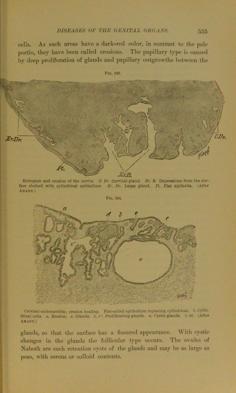cells. As such arcas have a dark-red color, in contrast to thc pale portio, tliey liave bcen eallcd crosions. The papillary type is catised hy deep proliferatiou of glaiuls and ])apillary outgrowths betwcen the FlO. 343. Cervical endonietritis; eroslon hcaling. Flat-cclled cpithellum replaciiiR cylindrlcal. h. Cylin- drical cells. a. Erosion, e. Glands. c, c'. Prolifenitlng glands. 0. f’ystlc glands, X 40. (ACcr Amann.) glands, so that the snrface bas a fi.ssnred ajipi'aranee. ^\ ith eysth? changes in the glands the follicnlar type oeenrs. The ovnles of Naboth are such retention eysts of the glands and inay be as large as peas, with serous or eolloid eontents. CI?K Eotroplon and eroslon of the cervix. C. Dr. Cervical gland. Er. B. Depressions from the siir- face clothed with cylludrical epithelium. Er. Dr. Large gland. l’l. Flat epithelia. (AAer Amann.) Fio. 344.