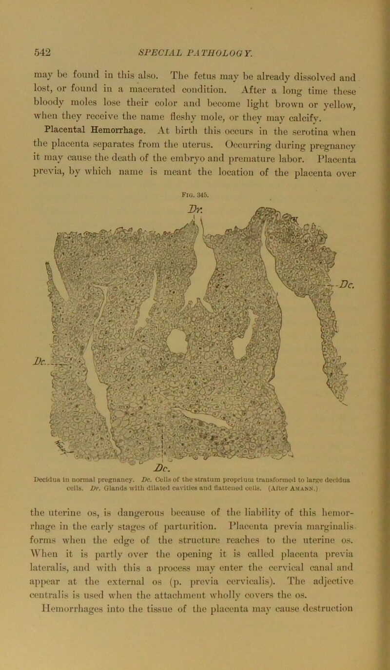 may be fouml in tliis also. Tlie fetus may be alreatly dissolved and lost, or fouud in a macerated condition. After a long time these bloody rnoles lose tlieir color and become light brown or yellow, when they reccive the naine fleshy mole, or tliey may calcify. Placental Hemorrhage. At birth this occurs in the serotina when the placenta separates from the iiterus. Occnrring during pregnancy it may cause the death of the embryo and premature labor. IMacenta previa, by which name is meant the location of the placenta over Fig. 345. Decidua in normal pregnancy. De. Cells of the stratnm proprium trausforineii to large decidua cells. Dr. Glands wilh dilated cavities and Qattened cells. (Alter A.man.n.) the uterine os, is dangerous because of the liability of this hemor- rhage in the early stages of parturition. Placenta previa marginalis forms when the edge of the structure reaches to the uterine os. When it is partly over the opening it is called jdacenta jirevia lateralis, and with this a process may enter the cervical canal and ajipear at the e.xternal os (p. previa cervicalis). The adjective centralis is used when the attachment wholly covers the os. Ilemorrhages into the tissue of the placenta may cau.se destructioii