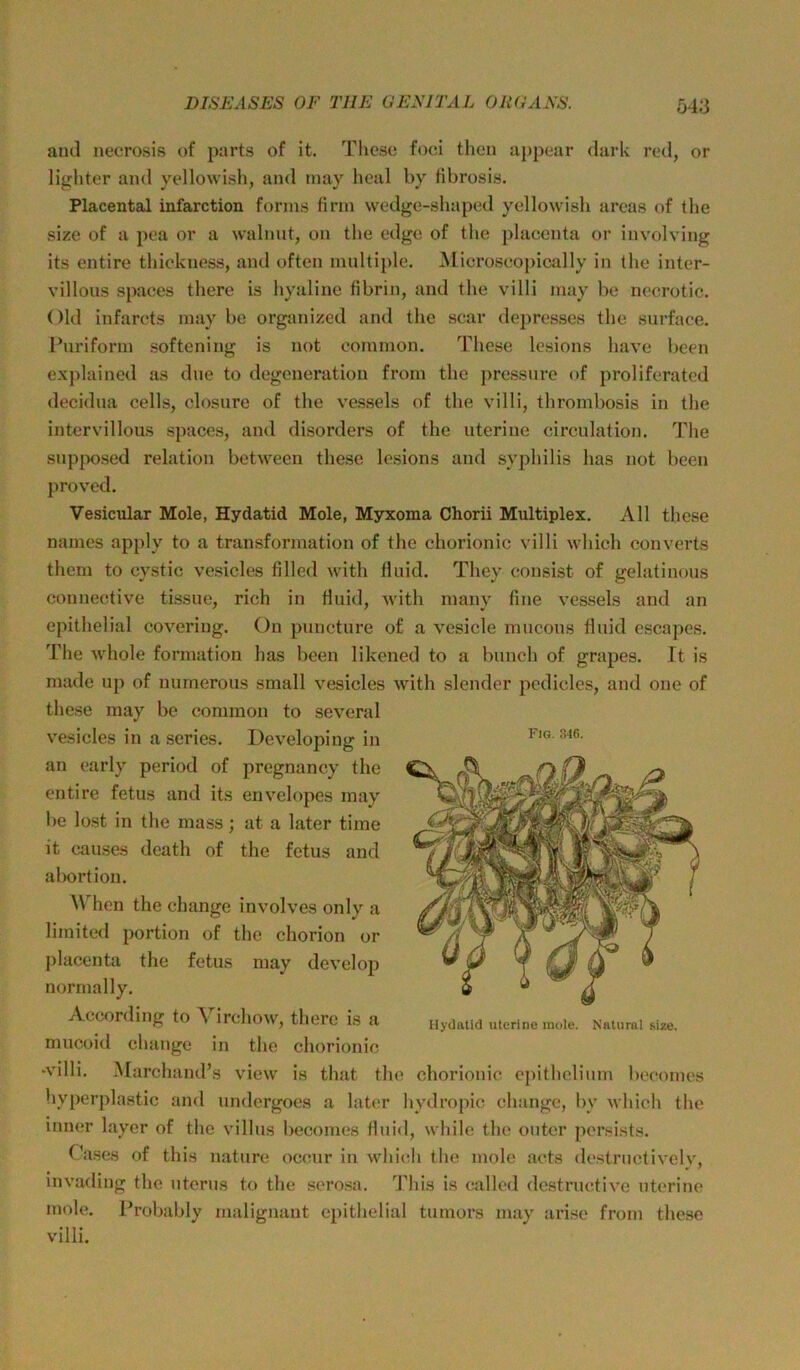 and necrosis of parts of it. These foei then appear dark red, or lighter and yellowish, and inay heal by tibrosis. Placental infarction forins firm wedge-shaped yellowish areas of the size of a pea or a walnut, on the edge of the placenta or iuvolving its entire thiekness, and often multiple. Mieroseopically in the inter- villous spaees there is hyaline fibrin, and the villi may be necrotic. Old infarets may bc organized and the sear dej)resses the surface. l’uriform softening is not common. These lesions have been explained as due to degeneratiou from the pressure of proliferated decidua cells, closure of the vessels of the villi, thrombosis in the intervillous spaees, and disorders of the uterine eirculation. The sup|X)sed relation between these lesions and Syphilis has not been proved. Vesicular Mole, Hydatid Mole, Myxoma Chorii Multiplex. All these names apply to a transformation of tlie chorionic villi which converts them to eystic vesicles fillcd with fluid. They consist of gelatinous connective tissue, rieh in fluid, with many fine vessels and an epithelial covering. On puneture of a vesicle mucous fluid escapes. The Avhole formation has been likened to a bunch of grapes. It is made up of numerous small vesicles with slender pcdicles, and one of these may be common to several vesicles in a series. Developing in an early period of pregnancy the entire fetus and its envelopes may be lost in the mass; at a later time it causes dcath of the fetus and abortion. When the change involves only a limited portion of the chorion or placenta the fetus may develop normally. According to Virehow, there is a mucoid change in the chorionio •villi. Marchand’s view is that tlie chorionic epithelium becomes hyperplastic and undergoes a later hydropic change, by wliich tlie inner layer of the villus becomes fluid, while the outor persists. Cases of this nature occur in whicih the mole acts destructivelv, invading the uterus to the serosa. This is called destruetive uterine mole. Probably malignant epithelial tumors may arise from these villi. Fig. 346. IlyOatid uterine mole. Natural size.