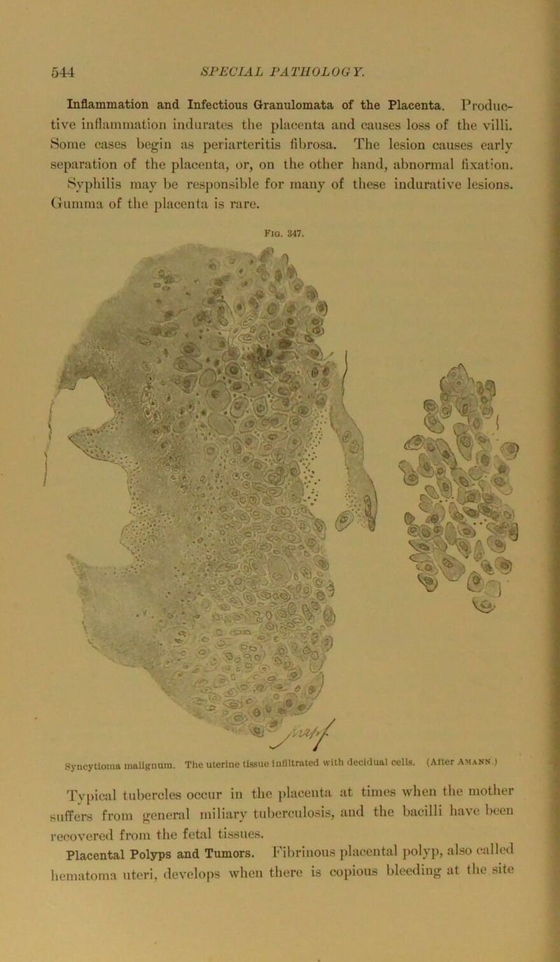 Inflammation and Infectious Granulomata of the Placenta. Produc- tive indamniation indurates the placenta and causes loss of the villi. Some cases begin as periarteritis fibrosa. The lesion causes early Separation of the placenta, or, on the other hand, abnormal fixation. Syphilis may be responsible for mauy of these indurative lesions. Gumma of the placenta is rare. Fiq. 347. Syncytioma inalignura. The uterine tLssue Inflltrated with decidual cells. (Alter Amann.) Tv[)ical tubcrcles occur in the placenta at times when the mother suffers from general miliary tuberculosis, and the bacilli havc been i’ecovered from the fetal tissues, Placental Polyps and Tumors. Fibrinous placental polyp, also etilled hematoma uteri, develops when there is copious bleeding at the site