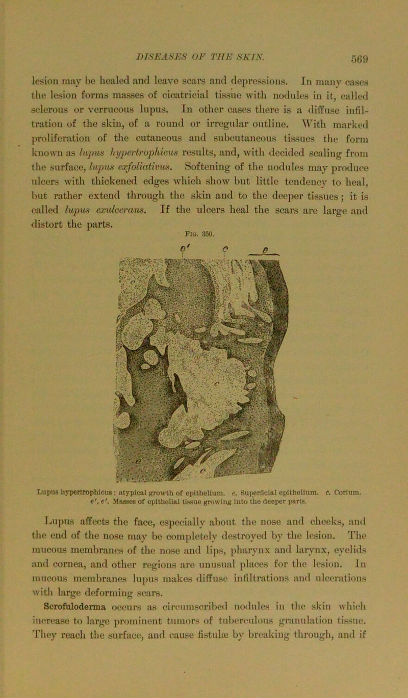 DISh'ÄSIÜS <)F TUE SKiy. 5(50 lesion niuy be healccl and loave scars and deprossions. In inany oason tlie lesion forms inasscs of cicjitricial tissue with juxlules in it, called sclerous or verrucous lupus. In othor cases there is a diffuse infil- tration of the skin, of a round or irregulär outline. Wdth marke»! proliferation of the cufaxneous and subeutaneous tissues the form known as hLpiis hypertrophicm results, and, with decided scaling froni the surface, hipm vxfoUativm. 8oftening of the nodules may produce ulcers with thickened cdges which show but little tendency Io heal, but nither extern! through the skin and to the deeper tissues; it is called hipm exidcemns. If the idcers heal the scars are large and ilistort the parts. Fio. 350. O' O Q_ Lupus hypertrophicug ; ntypical growlh of epithellum. e. Superficial epithelium. c. Corium. e', e'. Masaes of epithelial tis-sue growing into the deoper parts. Lupus affects the face, especiiilly about the nose and cheeks, aml the end of the nose may be complctoly destroyed by the lesion. d'lu“ mucous membranes of the nose iind lips, pharynx and larynx, oyelids and cornea, and other regions are unusual phices for tlie lesion. ln mucous membranes lupus makes diffuse intiltrations and ulcerations with large tleforming sctirs. Scrofuloderma occurs :is cin'umscribed nodides in the skin which in<wea.se to large prominent tuniors of tubenadous granulation tissue. They reach the surface, and cause fistuhe by breaking through, and if