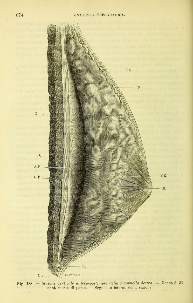 Fig. 188. — lezione verticale antera-posteriore della mammella destra. anni, morta di parto. — Segmento interno della sezione* C.Gc 1SÏ Donna di 2Î