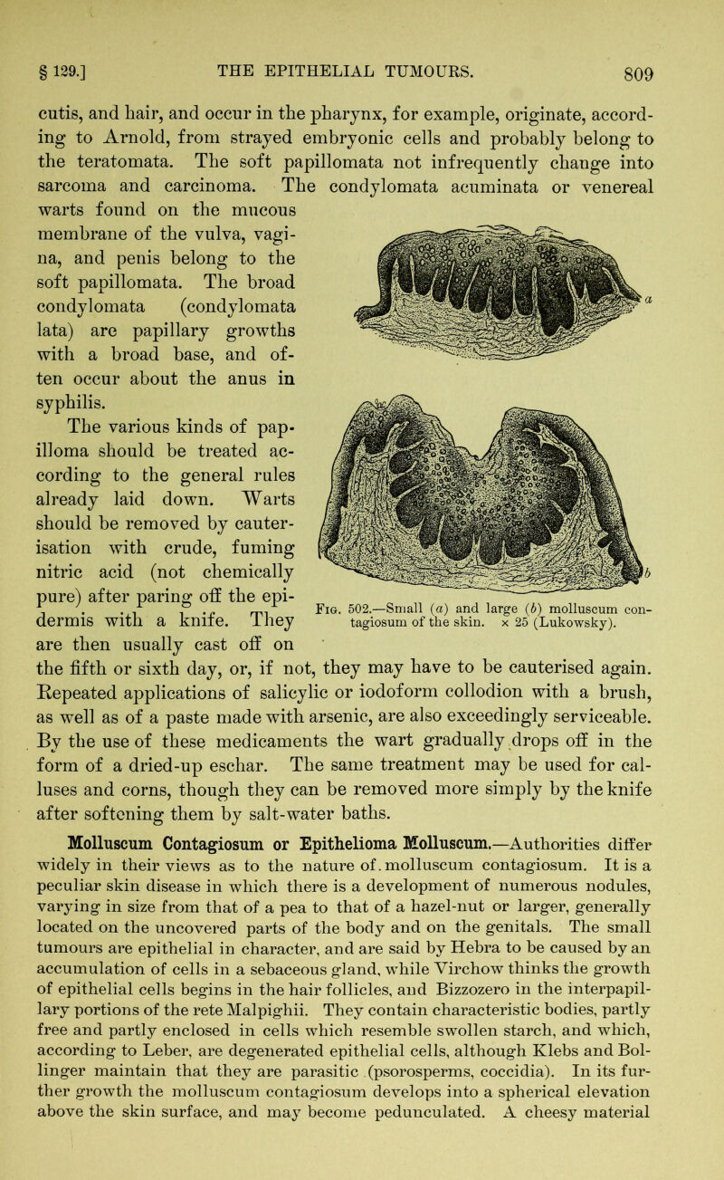 cutis, and hair, and occur in the pharynx, for example, originate, accord- ing to Arnold, from strayed embryonic cells and probably belong to the teratomata. The soft papillomata not infrequently change into sarcoma and carcinoma. The condylomata acuminata or venereal warts found on the mucous membrane of the vulva, vagi- na, and penis belong to the soft papillomata. The broad condylomata (condylomata lata) are papillary growths with a broad base, and of- ten occur about the anus in syphilis. The various kinds of pap- illoma should be treated ac- cording to the general rules laid down. Warts be removed by cauter- isation with crude, fuming nitric acid (not chemically pure) after paring oft the epi- dermis with a knife. They are then usually cast off on the fifth or sixth day, or, if not, they may have to be cauterised again. Repeated applications of salicylic or iodoform collodion with a brush, as well as of a paste made with arsenic, are also exceedingly serviceable. By the use of these medicaments the wart gradually drops off in the form of a dried-up eschar. The same treatment may be used for cal- luses and corns, though they can be removed more simply by the knife after softening them by salt-water baths. Molluscum Contagiosum or Epithelioma Molluscum—Authorities differ widely in their views as to the nature of. molluscum contagiosum. It is a peculiar skin disease in which there is a development of numerous nodules, varying in size from that of a pea to that of a hazel-nut or larger, generally located on the uncovered parts of the body and on the genitals. The small tumours are epithelial in character, and are said by Hebra to be caused by an accumulation of cells in a sebaceous gland, while Virchow thinks the growth of epithelial cells begins in the hair follicles, and Bizzozero in the interpapil- lary portions of the rete Malpighii. They contain characteristic bodies, partly free and partly enclosed in cells which resemble swollen starch, and which, according to Leber, are degenerated epithelial cells, although Klebs and Bol- linger maintain that they are parasitic (psorosperms, coccidia). In its fur- ther growth the molluscum contagiosum develops into a spherical elevation above the skin surface, and may become pedunculated. A cheesy material already should Fig. 502.—Small (a) and large (b) molluscum con- tagiosum of the skin, x 25 (Lukowsky).