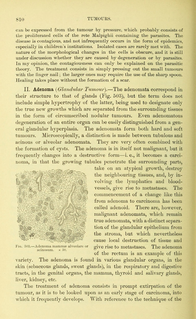 can be expressed from the tumour by pressure, which probably consists of the proliferated cells of the rete Malpighii containing the parasites. The disease is contagious, and not infrequently occurs in the form of epidemics, especially in children's institutions. Isolated cases are rarely met with. The nature of the morphological changes in the cells is obscure, and it is still under discussion whether they are caused by degeneration or by parasites. In my opinion, the contagiousness can only be explained on the parasitic theory. The treatment consists in simply pressing out the small tumours with the finger nail; the larger ones may require the use of the sharp spoon. Healing takes place without the formation of a scar. II. Adenoma (Glandular Tumour).—The adenomata correspond in their structure to that of glands (Fig. 503), but the term does not include simple hypertrophy of the latter, being used to designate only the true new growths which are separated from the surrounding tissues in the form of circumscribed nodular tumours. Even adenomatous degeneration of an entire organ can be easily distinguished from a gen- eral glandular hyperplasia. The adenomata form both hard and soft tumours. Microscopically, a distinction is made between tubulous and acinous or alveolar adenomata. They are very often combined with the formation of cysts. The adenoma is in itself not malignant, but it frequently changes into a destructive form—i. e., it becomes a carci- noma, in that the growing tubules penetrate the surrounding parts, take on an atypical growth, destroy the neighbouring tissues, and, by in- volving the lymphatics and blood- vessels, give rise to metastases. The commencement of a change like this from adenoma to carcinoma has been called adenoid. There are, however, malignant adenomata, which remain true adenomata, with a distinct separa- tion of the glandular epithelium from the stroma, but which nevertheless cause local destruction of tissue and give rise to metastases. The adenoma of the rectum is an example of this variety. The adenoma is found in various glandular organs, in the skin (sebaceous glands, sweat glands), in the respiratory and digestive tracts, in the genital organs, the mamma, thyroid and salivary glands, liver, kidney, etc. The treatment of adenoma consists in prompt extirpation of the tumour, as it is to be looked upon as an early stage of carcinoma, into which it frequently develops. With reference to the technique of the Fig. 503.—Adenoma mammae alveolare or acinosum. x 30.