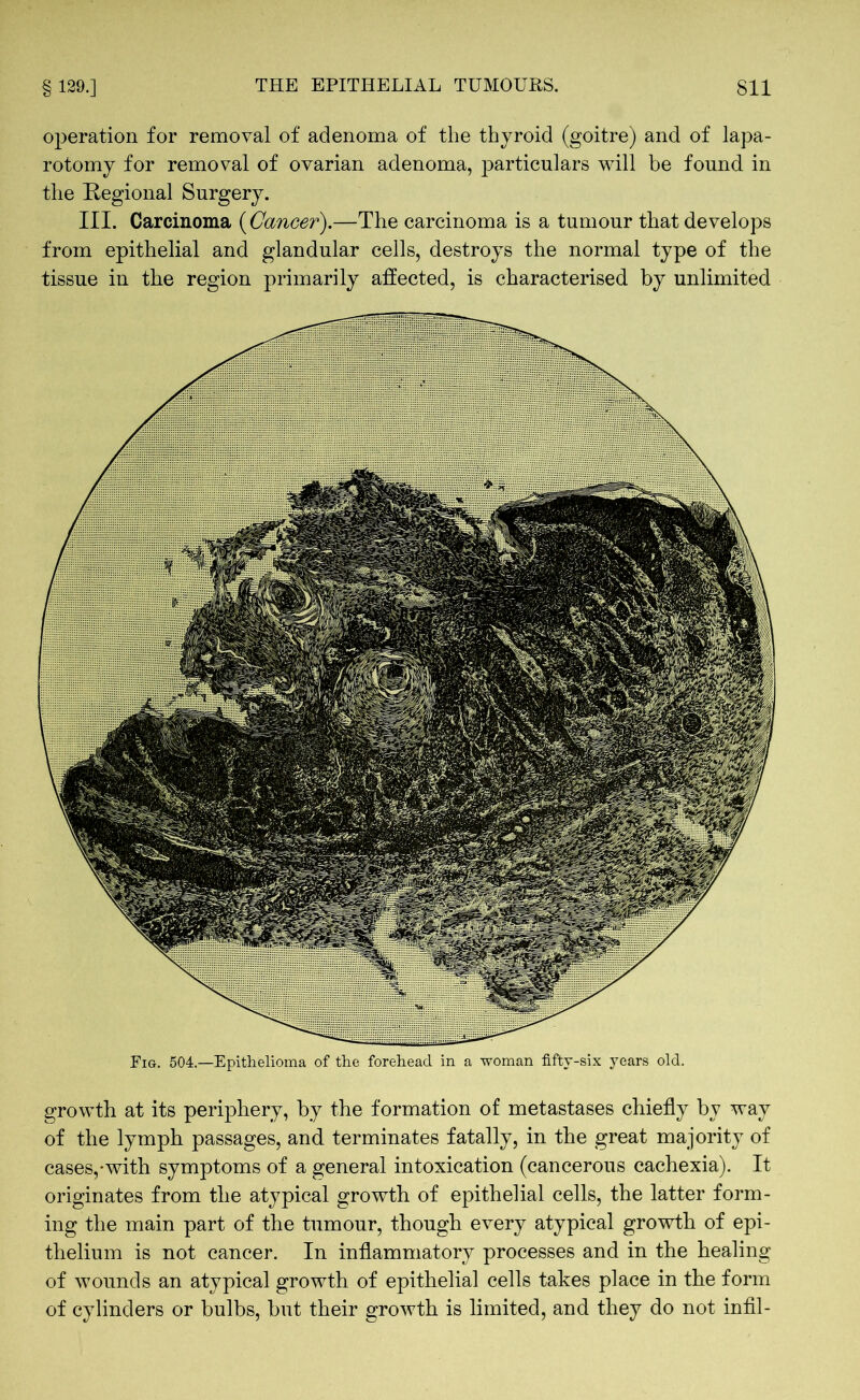 operation for removal of adenoma of the thyroid (goitre) and of lapa- rotomy for removal of ovarian adenoma, particulars will be found in the Regional Surgery. III. Carcinoma (Cancer).—The carcinoma is a tumour that develops from epithelial and glandular cells, destroys the normal type of the tissue in the region primarily affected, is characterised by unlimited Fig. 504.—Epithelioma of the forehead in a woman fifty-six years old. growth at its periphery, by the formation of metastases chiefly by way of the lymph passages, and terminates fatally, in the great majority of cases,-with symptoms of a general intoxication (cancerous cachexia). It originates from the atypical growth of epithelial cells, the latter form- ing the main part of the tumour, though every atypical growth of epi- thelium is not cancer. In inflammatory processes and in the healing of wounds an atypical growth of epithelial cells takes place in the form of cylinders or bulbs, but their growth is limited, and they do not infil-