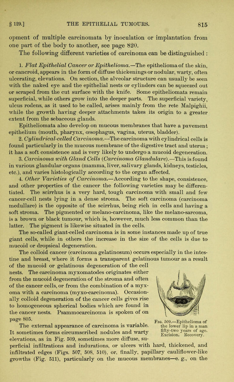opment of multiple carcinomata by inoculation or implantation from one part of the body to another, see page 820. The following different varieties of carcinoma can be distinguished : 1. Flat Epithelial Cancer or Epithelioma.—The epithelioma of the skin, or cancroid, appears in the form of diffuse thickenings or nodular, warty, often ulcerating, elevations. On section, the alveolar structure can usually be seen with the naked eye and the epithelial nests or cylinders can be squeezed out or scraped from the cut surface with the knife. Some epitheliomata remain superficial, while others grow into the deeper parts. The superficial variety, ulcus rodens, as it used to be called, arises mainly from the rete Malpighii, while the growth having deeper attachments takes its origin to a greater extent from the sebaceous glands. Epitheliomata also develop on mucous membranes that have a pavement epithelium (mouth, pharynx, oesophagus, vagina, uterus, bladder). 2. Cylindrical-celled Carcinoma.—The carcinoma with cylindrical cells is found particularly in the mucous membrane of the digestive tract and uterus ; it has a soft consistence and is very likely to undergo a mucoid degeneration. 3. Carcinoma with Gland Cells {Carcinoma Glandulare).—This is found in various glandular organs (mamma, liver, salivary glands, kidneys, testicles, etc.), and varies histologically according to the organ affected. 4. Other Varieties of Carcinoma.—According to the shape, consistence, and other properties of the cancer the following varieties may be differen- tiated. The scirrhus is a very hard, tough carcinoma with small and few cancer-cell nests lying in a dense stroma. The soft carcinoma (carcinoma medulläre) is the opposite of the scirrhus, being rich in cells and having a soft stroma. The pigmented or melano-carcinoma, like the melano-sarcoma, is a brown or black tumour, wfiiich is, however, much less common than the latter. The pigment is likewise situated in the cells. The so-called giant-celled carcinoma is in some instances made up of true giant cells, while in others the increase in the size of the cells is due to mucoid or dropsical degeneration. The colloid cancer (carcinoma gelatinosum) occurs especially in the intes- tine and breast, where it forms a transparent gelatinous tumour as a result of the mucoid or gelatinous degeneration of the cell nests. The carcinoma myxomatodes originates either from the mucoid degeneration of the stroma and often of the cancer cells, or from the combination of a myx- oma with a carcinoma (myxo-carcinoma). Occasion- ally colloid degeneration of the cancer cells gives rise to homogeneous spherical bodies which are found in the cancer nests. Psammocarcinoma is spoken of on page 805. The external appearance of carcinoma is variable. It sometimes forms circumscribed nodules and warty elevations, as in Fig. 509, sometimes more diffuse, su- perficial infiltrations and indurations, or ulcers with hard, thickened, and infiltrated edges (Figs. 507, 508, 510), or, finally, papillary cauliflower-like growths (Fig. 511), particularly on the mucous membranes—e. g., on the Fig. 509.—Epithelioma of the lower lip in a man fifty-two years of age. Excision. Recovery.