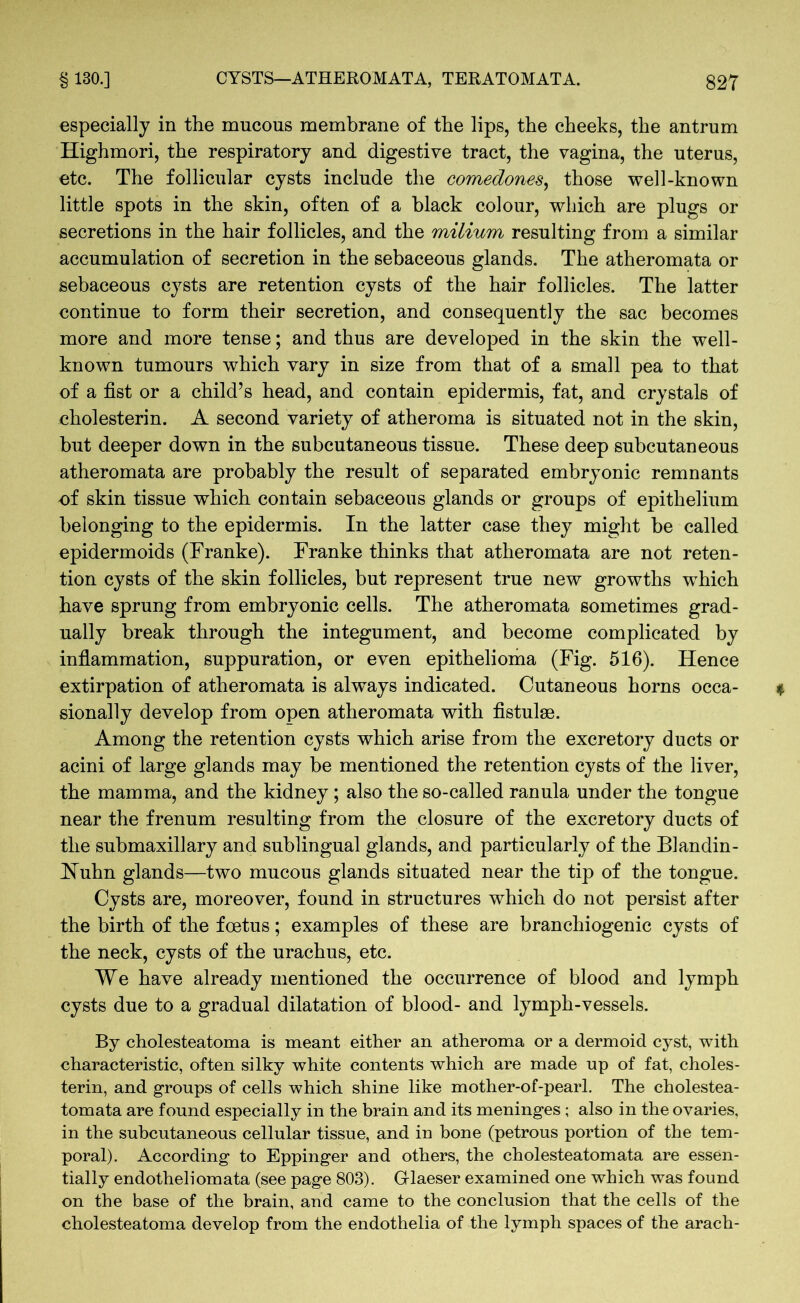 especially in the mucous membrane of the lips, the cheeks, the antrum Highmori, the respiratory and digestive tract, the vagina, the uterus, etc. The follicular cysts include the comedones, those well-known little spots in the skin, often of a black colour, which are plugs or secretions in the hair follicles, and the milium resulting from a similar accumulation of secretion in the sebaceous glands. The atheromata or sebaceous cysts are retention cysts of the hair follicles. The latter continue to form their secretion, and consequently the sac becomes more and more tense; and thus are developed in the skin the well- known tumours which vary in size from that of a small pea to that of a fist or a child’s head, and contain epidermis, fat, and crystals of cholesterin. A second variety of atheroma is situated not in the skin, but deeper down in the subcutaneous tissue. These deep subcutaneous atheromata are probably the result of separated embryonic remnants of skin tissue which contain sebaceous glands or groups of epithelium belonging to the epidermis. In the latter case they might be called epidermoids (Franke). Franke thinks that atheromata are not reten- tion cysts of the skin follicles, but represent true new growths wThich have sprung from embryonic cells. The atheromata sometimes grad- ually break through the integument, and become complicated by inflammation, suppuration, or even epithelioma (Fig. 516). Hence extirpation of atheromata is always indicated. Cutaneous horns occa- sionally develop from open atheromata with fistulse. Among the retention cysts which arise from the excretory ducts or acini of large glands may be mentioned the retention cysts of the liver, the mamma, and the kidney ; also the so-called ranula under the tongue near the frenum resulting from the closure of the excretory ducts of the submaxillary and sublingual glands, and particularly of the Blandin- Huhn glands—two mucous glands situated near the tip of the tongue. Cysts are, moreover, found in structures which do not persist after the birth of the foetus; examples of these are branchiogenic cysts of the neck, cysts of the urachus, etc. We have already mentioned the occurrence of blood and lymph cysts due to a gradual dilatation of blood- and lymph-vessels. By cholesteatoma is meant either an atheroma or a dermoid cyst, with characteristic, often silky white contents which are made up of fat, choles- terin, and groups of cells which shine like mother-of-pearl. The cholestea- tomata are found especially in the brain and its meninges ; also in the ovaries, in the subcutaneous cellular tissue, and in bone (petrous portion of the tem- poral). According to Eppinger and others, the cholesteatomata are essen- tially endotheliomata (see page 803). Glaeser examined one which was found on the base of the brain, and came to the conclusion that the cells of the cholesteatoma develop from the endothelia of the lymph spaces of the arach-