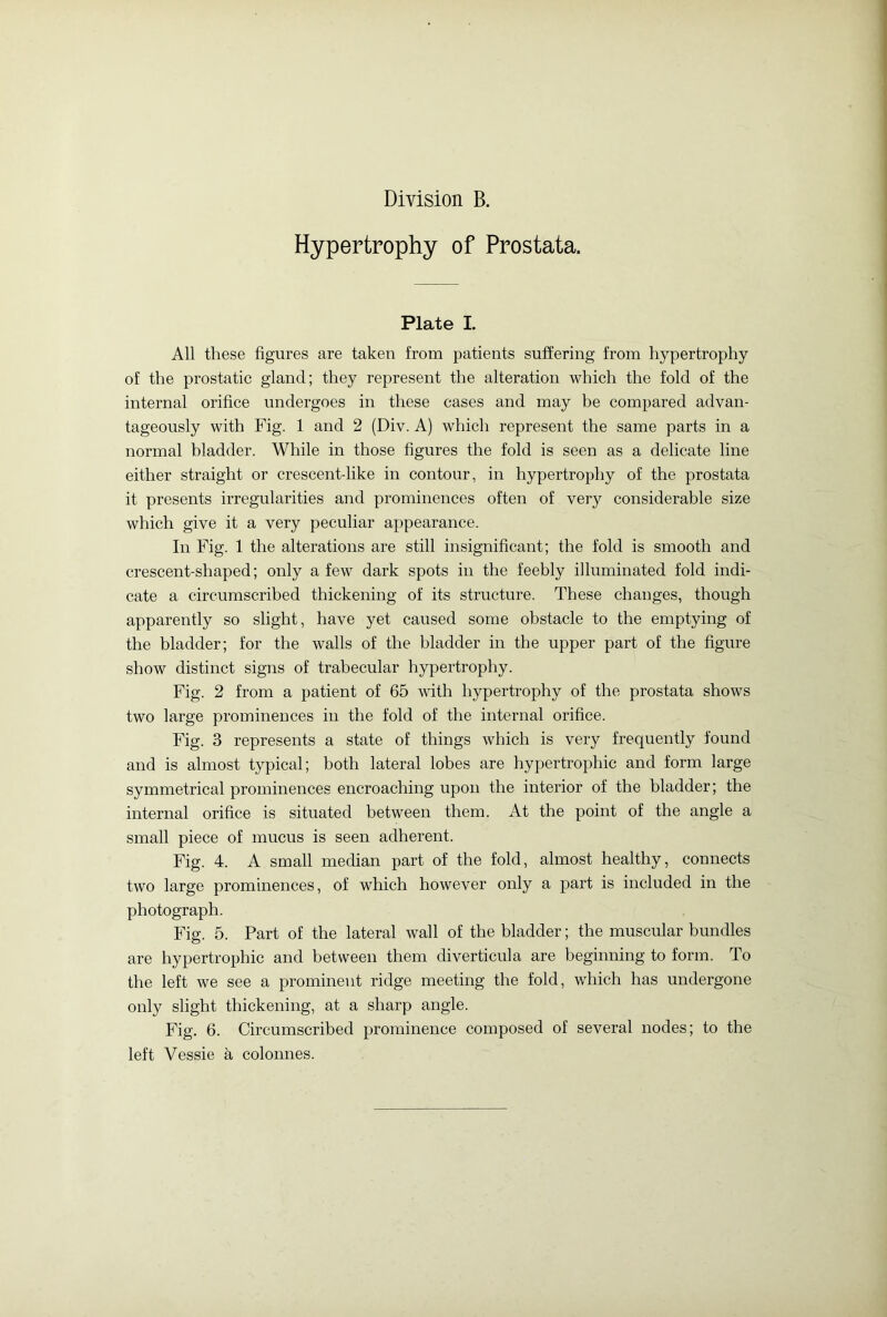 Hypertrophy of Prostata. Plate I. All these figures are taken from patients suffering from hypertrophy of the prostatic gland; they represent the alteration which the fold of the internal orifice undergoes in these cases and may be compared advan- tageously with Fig. 1 and 2 (Div. A) which represent the same parts in a normal bladder. While in those figures the fold is seen as a delicate line either straight or crescent-like in contour, in hypertrophy of the prostata it presents irregularities and prominences often of very considerable size which give it a very peculiar appearance. In Fig. 1 the alterations are still insignificant; the fold is smooth and crescent-shaped; only a few dark spots in the feebly illuminated fold indi- cate a circumscribed thickening of its structure. These changes, though apparently so slight, have yet caused some obstacle to the emptying of the bladder; for the walls of the bladder in the upper part of the figure show distinct signs of trabecular hypertrophy. Fig. 2 from a patient of 65 with hypertrophy of the prostata shows two large prominences in the fold of the internal orifice. Fig. 3 represents a state of things which is very frequently found and is almost typical; both lateral lobes are hypertrophic and form large symmetrical prominences encroaching upon the interior of the bladder; the internal orifice is situated between them. At the point of the angle a small piece of mucus is seen adherent. Fig. 4. A small median part of the fold, almost healthy, connects two large prominences, of which however only a part is included in the photograph. Fig. 5. Part of the lateral wall of the bladder; the muscular bundles are hypertrophic and between them diverticula are beginning to form. To the left we see a prominent ridge meeting the fold, which has undergone only slight thickening, at a sharp angle. Fig. 6. Circumscribed prominence composed of several nodes; to the left Vessie k colonnes.