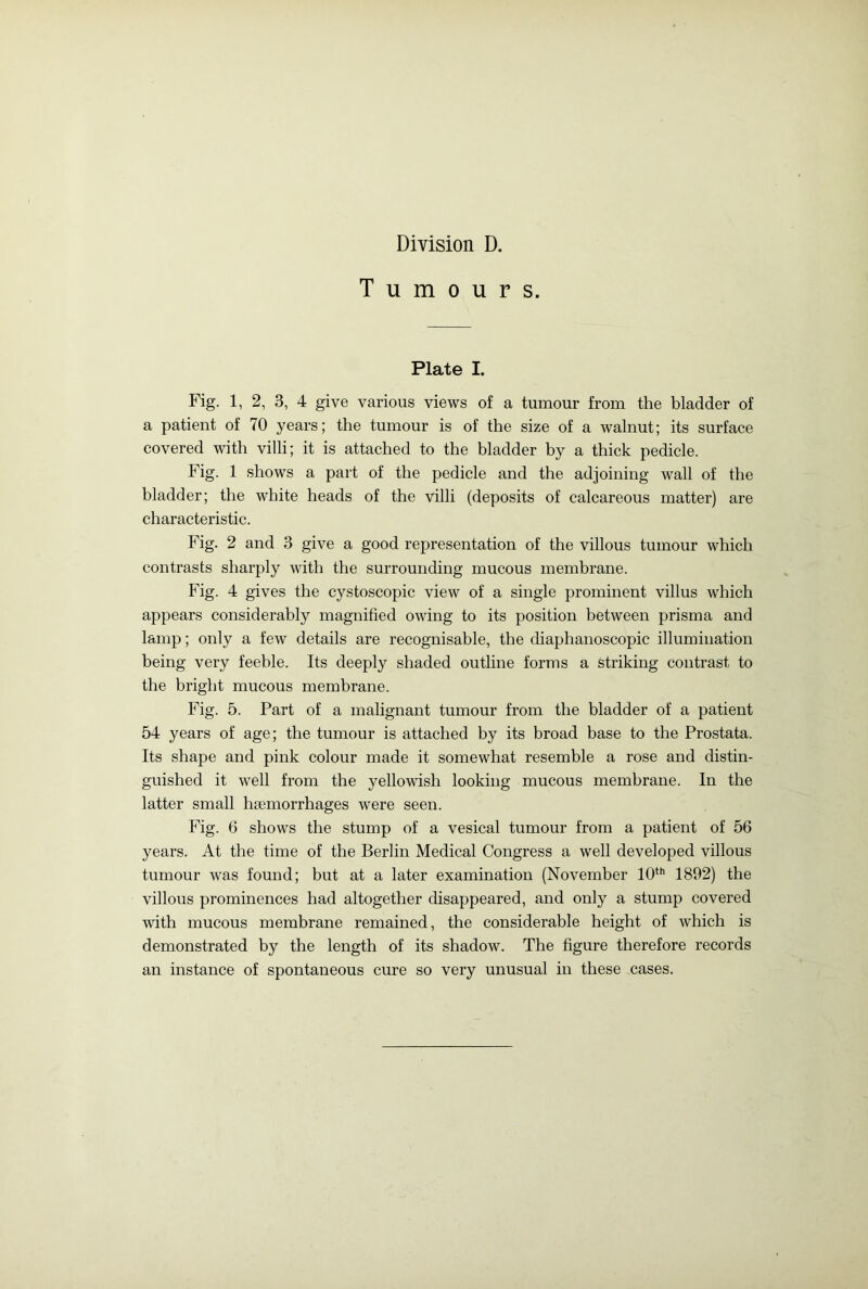 Tumours. Plate I. Fig. 1, 2, 3, 4 give various views of a tumour from the bladder of a patient of 70 years; the tumour is of the size of a walnut; its surface covered with villi; it is attached to the bladder by a thick pedicle. Fig. 1 shows a part of the pedicle and the adjoining wall of the bladder; the white heads of the villi (deposits of calcareous matter) are characteristic. Fig. 2 and 3 give a good representation of the villous tumour which contrasts sharply with the surrounding mucous membrane. Fig. 4 gives the cystoscopic view of a single prominent villus which appears considerably magnified owing to its position between prisma and lamp; only a few details are recognisable, the diaphanoscopic illumination being very feeble. Its deeply shaded outline forms a striking contrast to the bright mucous membrane. Fig. 5. Part of a malignant tumour from the bladder of a patient 54 years of age; the tumour is attached by its broad base to the Prostata. Its shape and pink colour made it somewhat resemble a rose and distin- guished it well from the yellowish looking mucous membrane. In the latter small haemorrhages were seen. Fig. 6 shows the stump of a vesical tumour from a patient of 56 years. At the time of the Berlin Medical Congress a well developed villous tumour was found; but at a later examination (November 10th 1892) the villous prominences had altogether disappeared, and only a stump covered with mucous membrane remained, the considerable height of which is demonstrated by the length of its shadow. The figure therefore records an instance of spontaneous cure so very unusual in these cases.