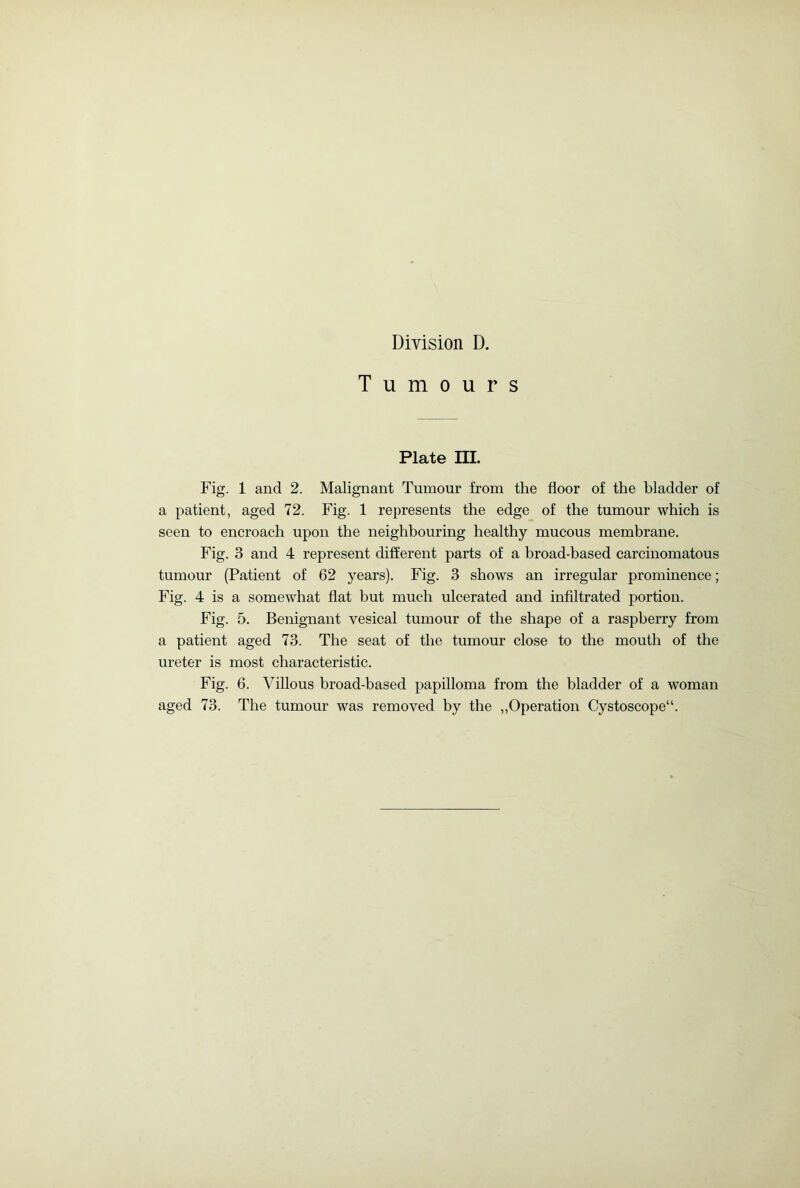 Tumours Plate III. Fig. 1 and 2. Malignant Tumour from the floor of the bladder of a patient, aged 72. Fig. 1 represents the edge of the tumour which is seen to encroach upon the neighbouring healthy mucous membrane. Fig. 3 and 4 represent different parts of a broad-based carcinomatous tumour (Patient of 62 years). Fig. 3 shows an irregular prominence; Fig. 4 is a somewhat flat but much ulcerated and infiltrated portion. Fig. 5. Benignant vesical tumour of the shape of a raspberry from a patient aged 73. The seat of the tumour close to the mouth of the ureter is most characteristic. Fig. 6. Villous broad-based papilloma from the bladder of a woman aged 73. The tumour was removed by the „Operation Cystoscope“.