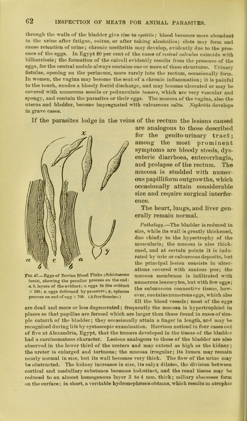 through the walls of the bladder give rise to cystitis ,* blood becomes more abundant in the urine after fatigue, coitus, or after taking alcoholics; clots may form and cause retention of urine; chronic urethritis may develop, evidently due to the pres- ence of the eggs. In Egypt 80 per cent of the cases of vesical calculus coincide with bilharziosis; the formation of the calculi evidently results from the presence of the eggs, for the central nodule always contains one or more of these structures. Urinary fistulae, opening on the perineum, more rarely into the rectum, occasionally form. In women, the vagina may become the seat of a chronic inflammation; it is painful to the touch, exudes a bloody foetid discharge, and may become ulcerated or may be covered with numerous sessile or pedunculate tumors, which are very vascular and spongy, and contain the parasites or their eggs. The mucosa of the vagina, also the uterus and bladder, become impregnated with calcareous salts. Nephritis develops in grave cases. If the parasites lodge in the veins of the rectum the lesions caused are analogous to those described for the genitourinary tract; among the most prominent symptoms are bloody stools, dys- enteric diarrhoea, enterorrhagia, and prolapse of the rectum. The mucosa is studded with numer- ous papilliform outgrowths, which occasionally attain considerable size and require surgical interfer- ence. The heart, lungs, and liver gen- erally remain normal. Pathology.—The bladder is reduced in size, while its wall is greatly thickened, due chiefly to the hypertrophy of the muscularis; the mucosa is also thick- ened, and at certain points it is indu- rated by uric or calcareous deposits, but the principal lesion consists iu ulcer- ations covered with sanious pus; the Fig. 47.—Eggs of Bovine Blood Flute {Schistosoma raucous membrane is infiltrated with bovis), showing the peculiar process on the end. numerous leucocvtes, but with few eggs; the submucous connective tissue, how- ever, contains numerous eggs, which also fill the blood vessels; most of the eggs are dead and more or less degenerated; frequently the mucosa is hypertrophied in places so that papillae are formed which are larger than those found in cases of sim- ple catarrh of the bladder; they occasionally attain a finger in length, and may be recognized during life by cystoscopic examination. Harrison noticed in four cases out of five at Alexandria, Egypt, that the tumors developed iu the tissue of the bladder had a carcinomatous character. Lesions analogous to those of the bladder are also observed in the lower third of the ureters and may extend as high as the kidney; the ureter is enlarged and tortuous; the mucosa irregular; its lumen may remain nearly normal in size, but its wall becomes very thick. The flow of the urine may be obstructed. The kidney increases in size, its calyx dilates, the division between cortical and medullary substance becomes indistinct, and the renal tissue may be reduced to an almost homogenous layer 3 to 4 mm. thick; miliary abscesses form on the surface; in short, a veritable hydronephrosis obtains, which results in atrophic a, 6, layers of the oviduct; c, eggs in the oviduct X 180; x, eggs deformed by pressure; y, spinous process on end of egg X 700. (After Sonsino.)