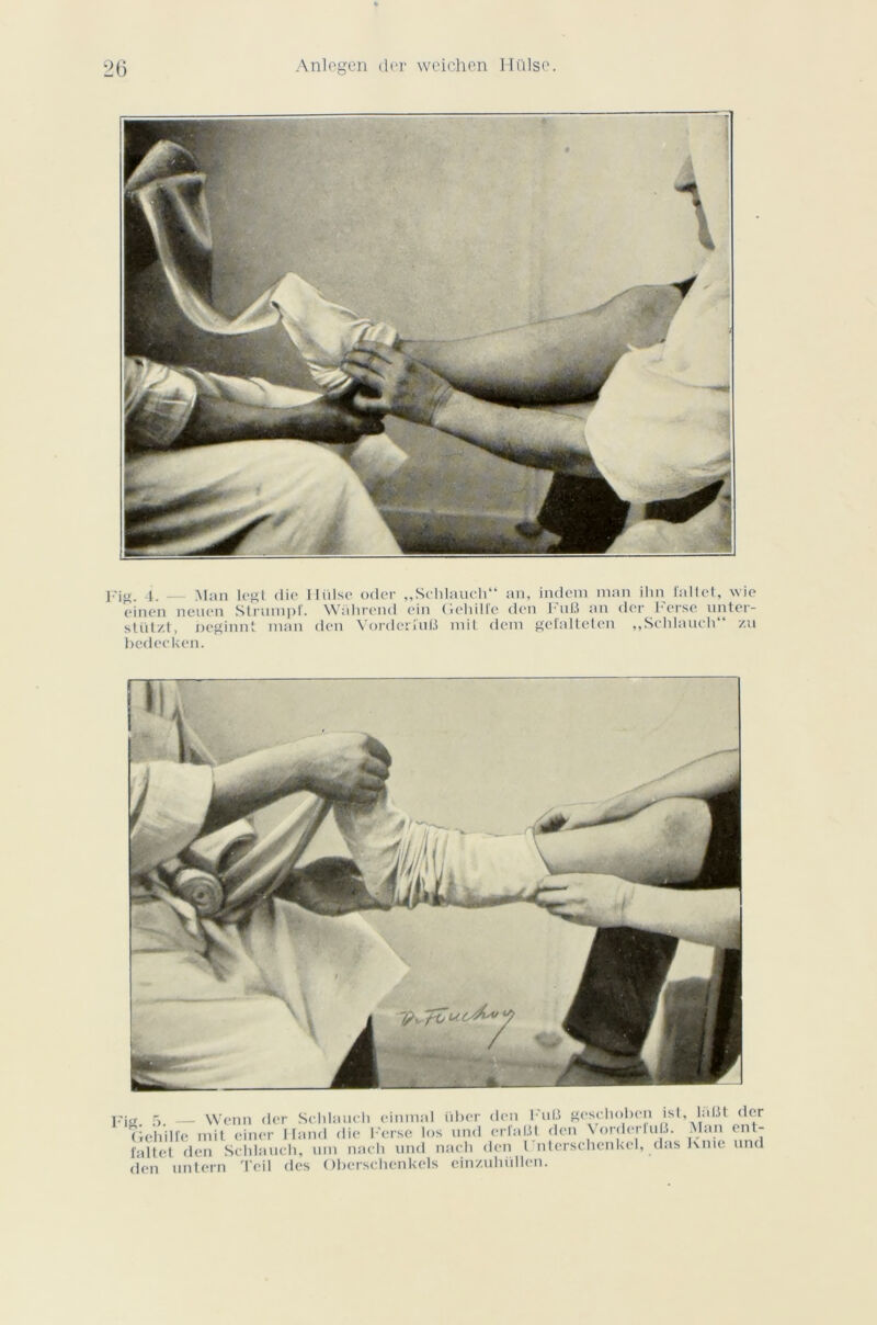 Fig. 4. — Man legt die Hiilse oder „ Schlauch an, indem man ihn fallet, wie einen neuen Strumpf. Wiihrend ein GeliilTe den I'iiB an der herse unter- stüt/.t, neginnt man den Vorderiuü mit déni gefalteten ,,Schlauch“ zu bedecken. Fit*. 5. — Wenn der Schlauch einmal iiber den Fuli geschobcn ist, laüt der Tichill'e mit einer Hand die l'erse Ins nnd erfalJt den \ordcrluB. Man ent- faltet den Schlauch, uni nach nnd nach den l nterschenkel, das Knie und den untern Teil des Oberschenkels einzuhüllen.