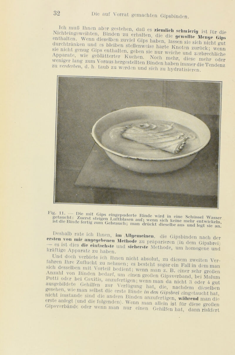 Die auf Vomit gemachten Gipsbinden. Ich mufi Ihnen aber gestehen da/3 es 7i<>miii.i. ^1 • • . A , Nichteingeweihten, Binden zu êrhalten die dit' a,,Zllu'\iZ, r' ent-halte» Wenn dieselben zuvici Gips haben asfen se si  n7chtsut durchtranken und es blolbon stcllenweise Parte Knot»n z.mieP ,L8 Sie nicht genug Cips enthalten, geben sic nur weiehe uVd Se’chTieïle Apparate, wie geblatterter Kuchen Nneh mPh, ,• z-rdrecbhche SS» Fig. 11. - getaucht: Zu(‘i’sV'sloi''en T!m hl'tIon «,!r'° wird ,in. einc Sclnissel Wasser ist die Dinde fertig zum Gebrauch ; ffiS.’ Dcshalb rate ich Ihnen, im All»emeinen. die Gipsbinden nach der - ™ni,7d.:,:'rdTV*n zu PraparicroMin dm G^sbrei siol,mteMcthode'um homo«™ fahren fhrf Zn^eM iCh ltl‘ncn nicht absoklt’ zu diesem zweiten Ver- nf, ,Tn; es bcstebt so^cin Fallin demman a.beiî,mit Vortei1 dédient; wenn man z. B. einer sehr grofier, PoUi od^rbei1 pQAcitis°' n^' fu™.einen robcn Gipsverband, bei Malum ml iril eS ’ anznfertigen; wenn man da nicht 3 oder 4 gut gesehen wieman'selbst d'i^ X,TlllSlmg hat> Gie, nachdem dieselben . , . n’ ryian selbst die erste Bmde in den Givsbrei eingetaucht hat ^““und^;ltai,f'? und/J foigenden). Wenn man ailein ist für diese grofien Gipsverbande oder wenn man nur einen Gehilfen hat, dann riskicrl