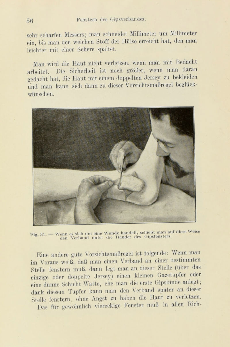 sehr seharfen Messers; inan schneidet Millimeter uni Millimeter ein, bis man den weichen Stoff der Hülse erreicht hat, den man leichter mit einer Schere spaltet. Man wird die Haut nicht verletzen, wenn man mit Bedacht arbeitet. Die Sicherheit ist noch groBer, wenn man daran gedacht hat, die Haut mit einem doppelten Jersey zu beldeiden und man kann sich dann zu dieser VorsichtsmaBregel beglück- wünschen. Fig. 31. — Wenn den es sicli uni eine Wunde handelt, schicbt man auî dieseWeise Yerband unter die Rander des Gipsfensters. Eine andere gute VorsichtsmaBregel ist folgende: Wenn man im Voraus weiB, dafi man einen Verband an einer bestimmten Stelle fenstern muB, dann legt man an dieser Stellc (über das einzige oder doppelte Jersey) einen kleinen Gazetupfer oder eine diinne Schicht Watte, ehe man die erste Gipsbinde anlegt; dank diesem Tupfer kann man den Verband spater an dieser Stelle fenstern, ohne Angst zu haben die Haut zu verletzen. Das fiir gewôhnlich viereckige Fenster muB in allen Rich-