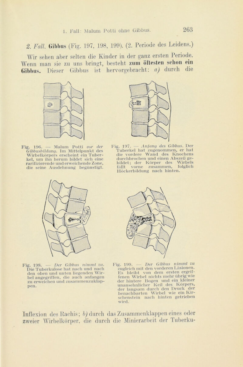 2. Fàll. Gibbus (Fig. 197, 198, 199). (2. Période des Leidens.) Wir selien aber selten die Kinder in der ganz ersten Période. Wenn man sie zu uns bringt, besteht zum oftesten selion ein Gibbus. Dieser Gibbus ist hervorgebracht : a) durch die Fig. 196. — Maluni Potti vor der Gibbusbildung. 1m Mittelpunkt des Wirbelkôrpers erscheint ein Tuber- kel, uni ihn herum bildet sicli eine rarifizierende und erweichende Zone, die seine Ausdehnung begiinstigt. Fig. 198. — Der Gibbus nimmt zu. Die Tuberkulose liât nach und nach den oben und unten liegenden Wir- bel angegriffen, die aucli anfangen zu erweichen und zusammenzuklap- pen. Fig. 197. —■ Anfang des Gibbus. Der Tuberkel liât zugenommen, er liât die vordere Wand des Knochens durchbrochen und einen AbszeB ge- bildet; der Kôrper des Wirbels fâllt vorne zusammen, folglich Hôckerbildung nach liinten. Fig. 199. — Der Gibbus nimmt zu zugleich mit den vorderen Lâsionen. Ks bleibt von dem ersten ergril- fenen Wirbel niclits nielir übrig de der liintere Bogen und ein kleiner unansehnlicher Keil des Ivôrpers, der langsam durch den Druck der benaclibarten Wirbel wie ein Kir- schenstein nach liinten getrieben wird. Inflexion des Rachis; zweier Wirbelkorper. b) durch das Zusammenklappen eines oder die durch die Minierarbeit der Tuberku-