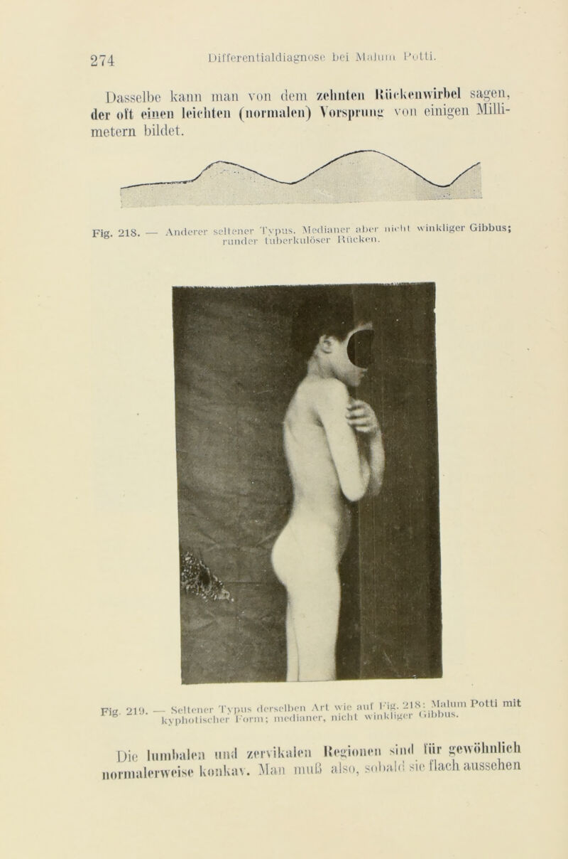 Differentialdiagnose bci MaJuiu Potti. Dasselbe kann inan von dem zchuten H.iiekenwirbel sagen, der oit einen hdi'liton (normalcn) Yorspruntt von einigen Milli- metern bildet. Fi«. 218. — Antlcrer seltener Typus. Medianer aber nielit runder tubcrkulôser Riicken. winkliger Gibbus; ii 'i' i niiinn ii iit r.111* P*îc 218: Malum o 111 Fi. 210. — Seltener I ypus dersclben Ait \m . .un i - ... . kyphotischer l'orm; medianer, nicht winkliger Gibbus. mit Die lumbabsi und normalenvoise konkav zmikalen Regionen siml tïir gewohnlich Man mu B also, subab! sie flach aussehen