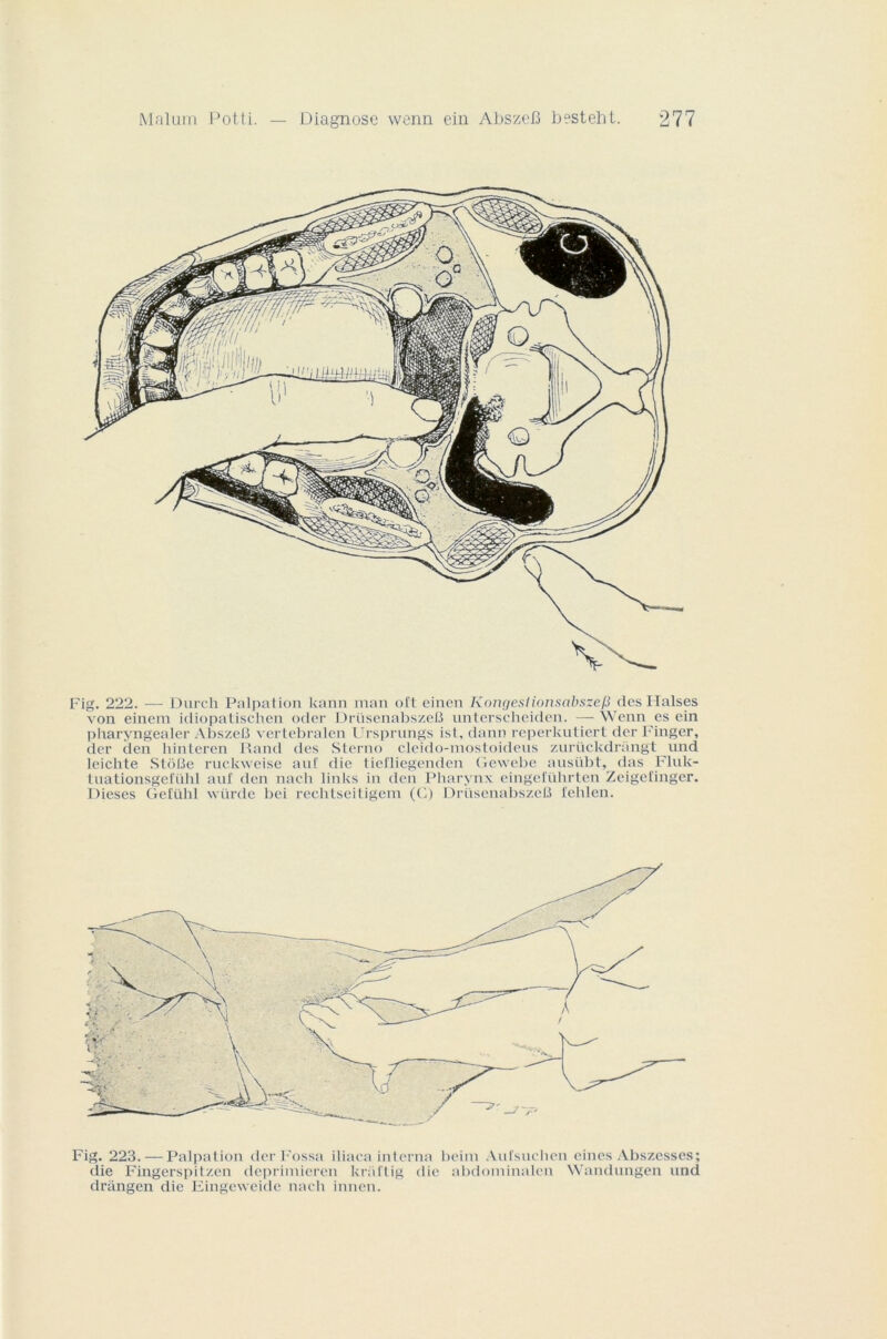 Fig. 222. — Durch Palpation kann man ol't einen Kongeslionsabsze/3 des Halses von einem idiopatischen oder Drüsenabszelî unterscheiden. — Wenn es ein pharyngealer AbszeB vertebralen Ursprungs ist, dann reperkutiert der Finger, der den hinteren Rand des .Sterno cleido-mostoidens zurückdrangt und leichte StoBe ruckweise auf die tiefliegenden Gewebe ausübt, das Fluk- tuationsgefiihl auf den nacli links in den Pharynx eingeluhrten Zeigel'inger. Dieses Gefühl würde bei rechtseitigem (G) DrüsenabszeB fehlen. Fig. 223. — Palpation derFossa iliaca interna beim Aufsuchen eines Abszesses; die Fingerspitzen deprimieren kraftig die abdoininalen Wandungen und drangen die Eingeweide nach innen.