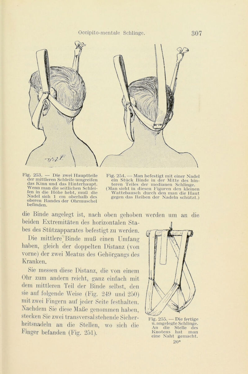 Fig. 253. — Die zwei Hauptteile der mittleren Schleife ümgreifen das Kinn und das Hinterhaupt. Wennman die seitlichen Schlei- len in die Hôhe hebt, muB die Nadel sich 1 cm oberhalb des oberen Randes der Ohrmuschel befinden. Fig. 254. — Man bcfestigt mit einer Nadel ein Stück Binde in der Mille des hin- teren ïeiles der medianen Schlinge. (Man sieht in diesen Figuren den kleinen Wattebausch durch den man die Haut gegen das Reiben der Nadeln schiitzt.) die Binde angelegt ist, nach oben gehoben werden um an die beiden Extremitâten des horizontalen Sta- bes des Stiitzapparates bcfestigt zu werden. Die mittlcre Binde muB einen Umfann; haben, gleich der doppelten Distanz (von vorne) der zwei Meatus des Gehorgangs des Kranken. Sie messen diese Distanz, die von einem Gbr zum andern reicht, ganz einfach mit dem mittleren Teil der Binde selbst, den sie auf folgende Weise (Fig. 249 und 250) mit zwei Fingern auf jeder Seite festhalten. Nach dem Sie diese Mafie genommen haben, stecken Sie zwei transversal stehende Sicher- heitsnadeln an die Stellen, wo sich die Finger befanden (Fig. 251). Fig. 255. — Die fertige u. angelegte Schlinge. An die Sicile des Knotens hat man eine Naht gemacht. 20*