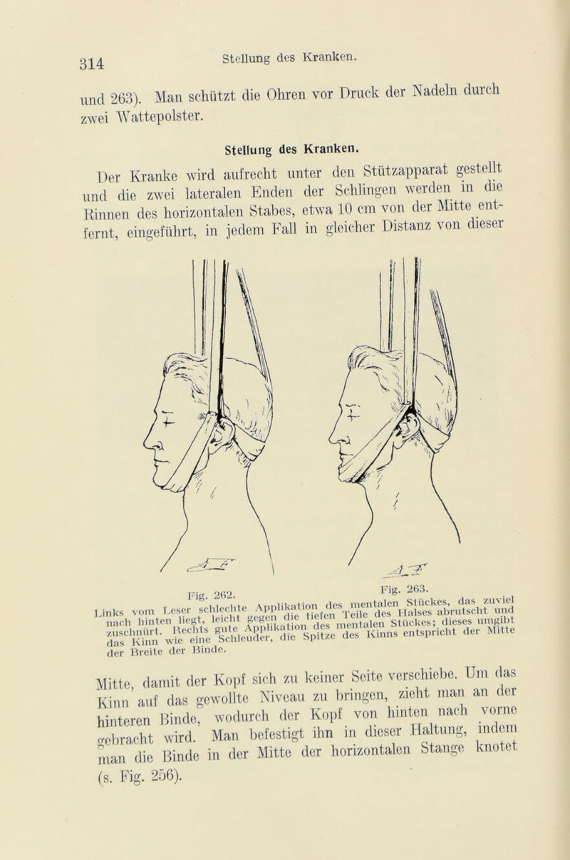 und 263). Man schützt die Ohren vor Druck der Nadeln durch zwei Wattepolster. Stellung des Kranken. Der Kranke wird aufrecht unter den Stützapparat gestellt und die zwei lateralen Enden der Schlingen werden m die Rinnen des horizontalen Stabes, etwa 10 ctn von der Mitte eut - fernt, eingeführt, in jedem Fall in gleicher Distanz von dieser Links vom Leser schlechte Ap pl1 *2'' r(>n Veilc des Ilalses abrutscht und nach hinten liegt, leicht 8egen mentalen Stückes; dieses umgibt -fKÎ- X fcï,e^rrVuK.nns eMsericM der Mitte der Breite der Binde. Mitte damit der Kopf sieh zu keiner Seite verschiebe. Um das Kinn atif das gewollte Niveau zu bringen, zieht man au der hinteren Binde, wodureli der Kopf von hinten nach vorne gebracht wird. Man befestigt ihn in dieser Haltung, mdem man die Binde in der Mitte der horizontalen Stange knotet (s. Fig. 256).