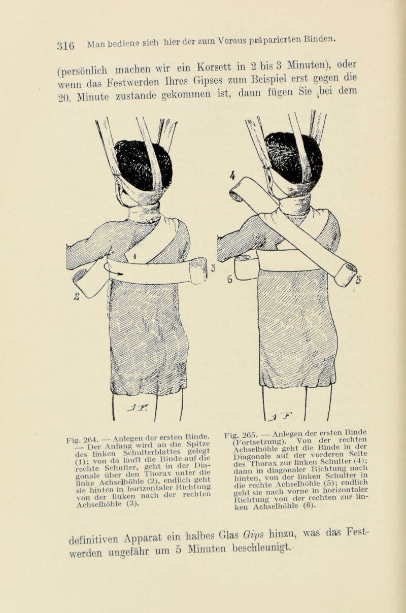 bediene sich hier der zum Voraus prâparierten Binden. 316 Man (nersonlicli machen wir ein Korsett in 2 bis 3 Minuten), oder wenn das Festwerden Ihres Gipses zum Beispiel erst gegen die 20. Minute zustande gekommen ist, daun fiigen Sic Lbei dem pjrï, 264. — Anlegen der ersten Binde. — Der Anfang wird an die Spitze des linken Schulterblattes gele&t (IV von da lauft die Binde aufdie rechte Schnlter, gcht in der Dia- gonale liber den Thorax unter die îinke Achselliôhle (2), endlich gcht sie hinten in horizontaler I.ichtung von der linken nach der rechten Achselhôhle (3). pig. 265. — Anlegen der ersten Binde (Fortsetzung). Von der rechten Achselhôhle gelit die Binde m der Diagonale anf der vordercn Seite des Thorax zur linken Schnller (4) ; dann in diagonaler Richtung nach hinten, von der linken Schulter m die rechte Achselhôhle (o); endlich geht sie nach vorne in horizontaler Richtung von der rechten zur lin- definitiven Apparat cin halbes Glas Gips hinzu, was (las Fest