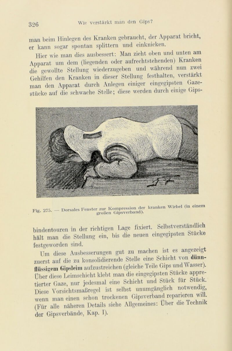 Wie vorstârkt man den Gips? man beim Hinlegen des Kranken gebraucht, der Apparat bncht, er kann sogar spontan splittern und einknicken. Hier wie man dies ausbessert: Man zieht oben und unten am Apparat uni dem (liegenden oder aufrechtstehenden) Kranken die o-ewollte Stellung wiederzugeben und wâhrend mm zwei Gehilfen den Kranken in dieser Stellung festhalten, verstârkt man den Apparat durch Anlegen einiger eingegipsten Gaze- stücke auf die schwache Stelle; diese werden durch emige Gips- Fig. 275. Dorsales Fenstcr tr zur Kompression (1er kranken Wirbel (in einem roüen Gipsverband). bindentouren in der richtigen Lage fixiert. Selbstverstândlich hait man die Stellung ein, bis die neuen eingegipsten Stucke festgeworden sind. Um diese Ausbesserungen gut zu machen ist es angezeigt zuerst auf die zu konsolidierende Stelle eine Schieht von (luiui- fliissi-em Gipslcim aufzustreichen (gleiehc Telle (bps und W assci ). über diese Leimschicht klebt man die eingegipsten Stücke apprc- tiertor Gaze, nur jedesmal eine Schieht und Stuek fur Stuck Diese VorsichtsmaBregel ist sclbst unumganglich notwendig, wenn man einen schon trockenen Gipsverband repaneren wiU. (Für aile naheren Details siehe AUgememes: Uber die Technik der Gipsverbânde, Kap. 1).