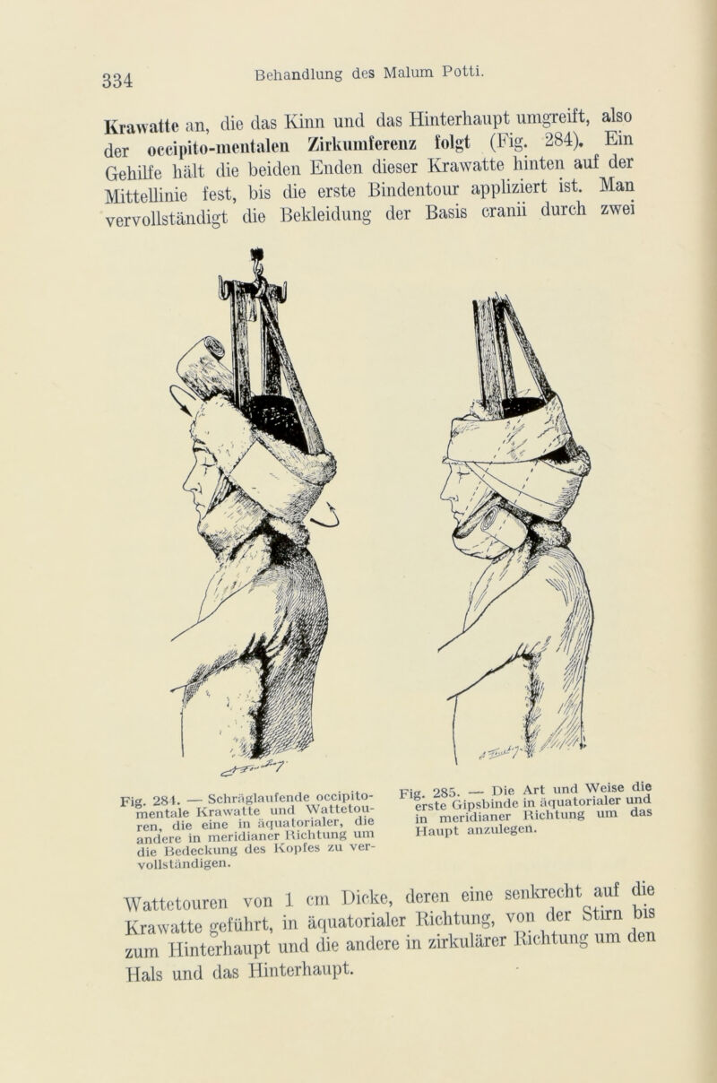 Krawattc an, die das Kinn und das Hinterhaupt umgreift, also der occipito-mentalen Zirkumferenz ïolgt (Fig. 284). Ein Gehilfe hait die beiden Enden dieser Krawatte hinten auf dei Mittellinie fest, bis die erste Bindentour appliziert ist. Man vervollstândigt die Bekleidung der Basis cranu durch zwei Fi 284. — Schrâglaufende occipito- mentale Krawatte und Wattetou- ren, die eine in àquatorialer, die andere in meridianer Riclitung um die Bedeckung des Kopfes zu ver- vollstandigen. FJo. 285. — Die Art und Weise dl® erste Gipsbinde in aquatormler und in meridianer Riclitung um das Haupt anzulegen. Wattetouren von 1 cm Dicke, deren eine senkrecht auf die Krawatte geführt, in àquatorialer Riclitung, von der Stirn b zum Hinterhaupt und die andere in zirkularer Richtung um t Hais und das Hinterhaupt.