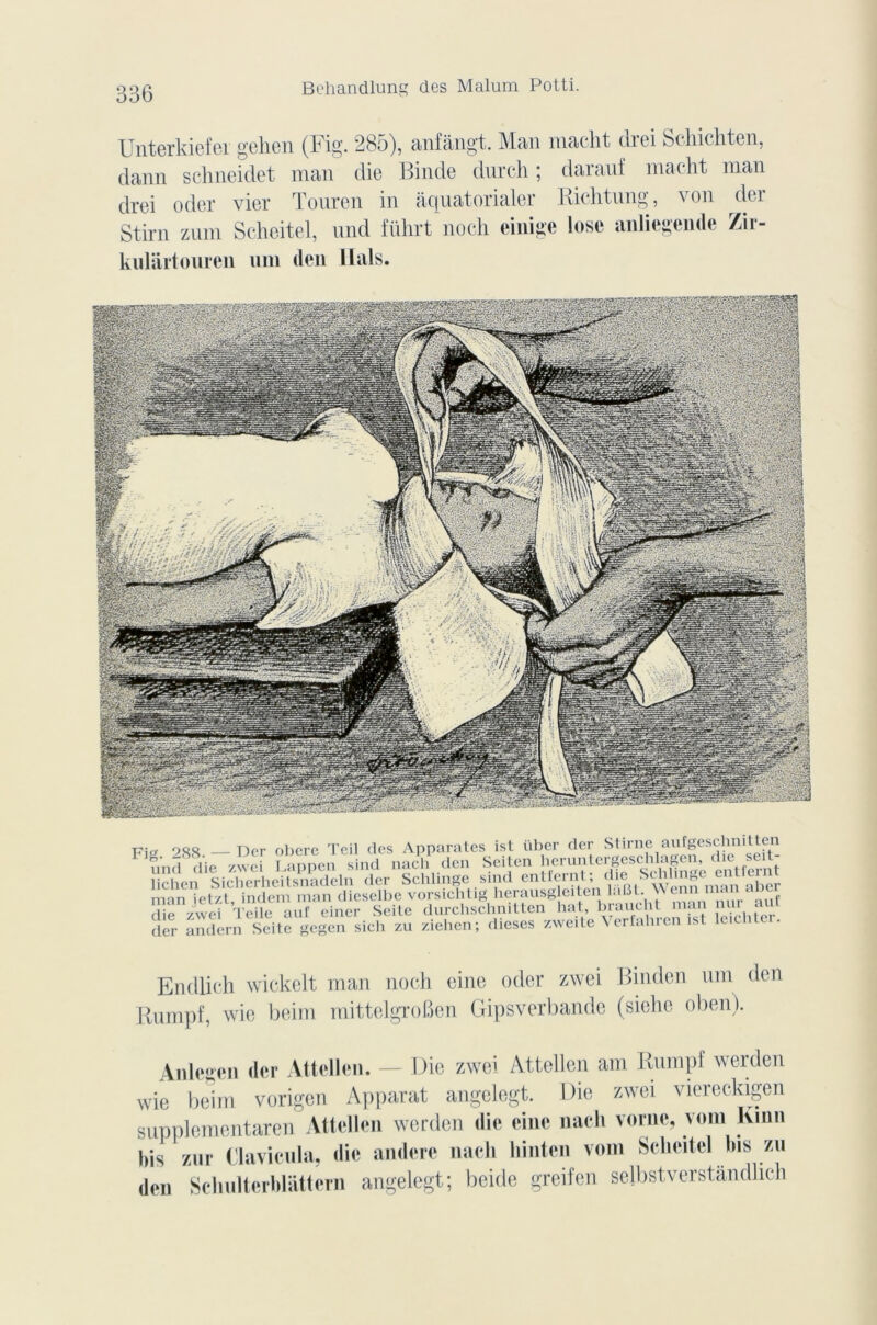 Unterkiefei gehen (Fig- 285), anfàngt. Mail macht diei Schichten, dann schneidet man die Binde durch ; darauf macht man drei oder vier Touren in àquatorialer Richtung, von der Stirn zum Seheitel, und führt noch einige losc anliegende Zir- kulartouren uni den liais. ass SS» ' rtîîsPÇU SlIlSÉi T7io. 900 j)or obéré Teil des Apparates isl über der Stirne aufgeschnitten ’HhàMAtus jnçpgesg der andern Seite gegen sich zu ziehen; dieses zweite Verfahren ist leic Endlich wickelt man noch eine oder zwei Binden uni den Rumpf, wie beim mittelgroben Gipsverbande (siehe oben). Anlegen der Attcllen. — Die zwei Attellen am Rumpf werden wie beim vorigen Apparat angelegt. Die zwei viereclogen supplementaren Attellen werden die eine nach vorne, vont Kinn bis zur Clavicula, die andere nach liinten vom Seheitel bis zu den Schulterblâttem angelegt; beide greifen selbstverstândlich