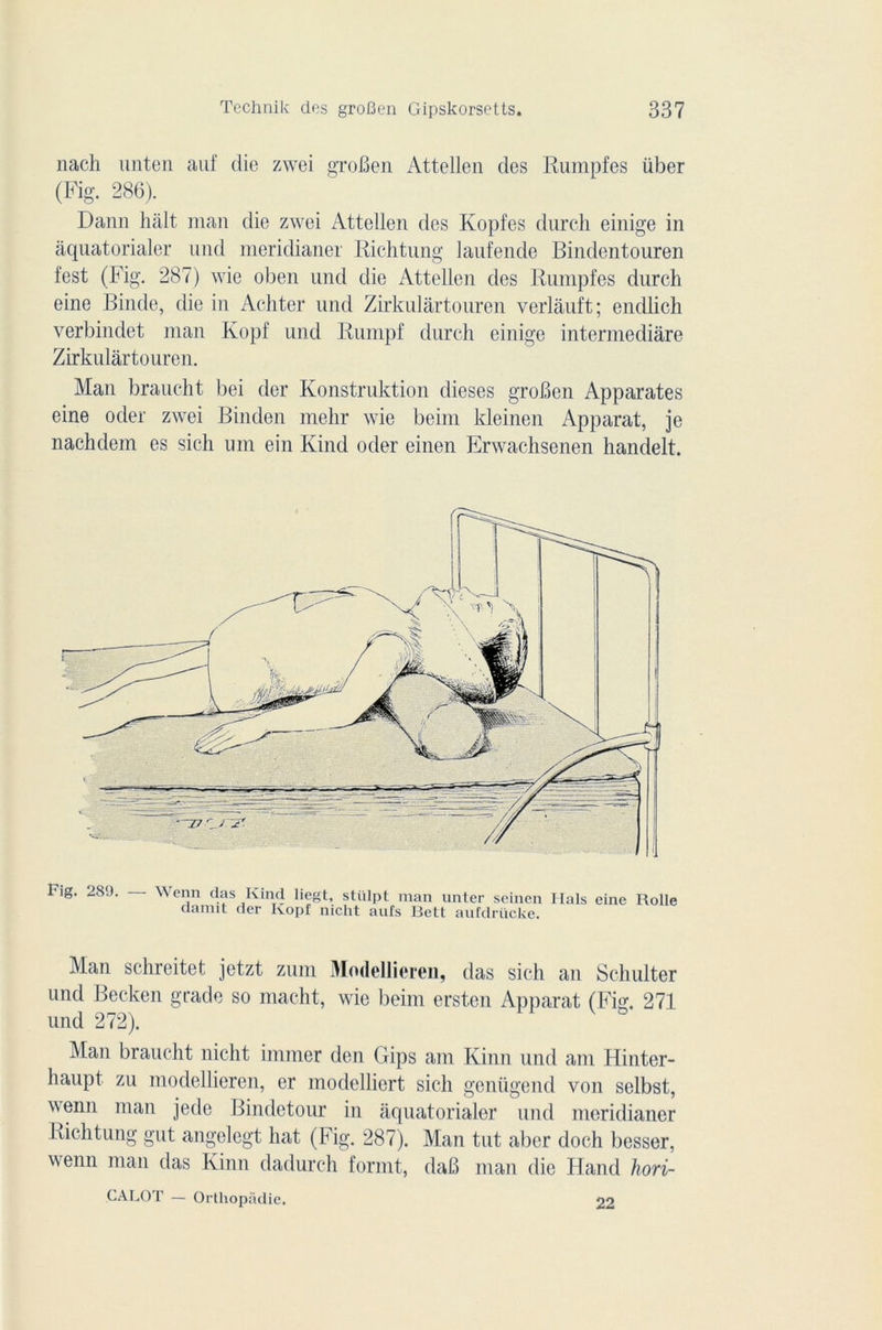 nach unten auf die zwei groBen Attellen des Rumpfes über (Fig. 286). Dann hait man die zwei Attellen des Kopfes durch einige in âquatorialer nnd meridianer Richtnng laufende Bindentouren fest (Fig. 287) wie oben nnd die Attellen des Rumpfes durch eine Binde, die in Achter und Zirkulârtouren verlauft; endlich verbindet man Kopf und Rumpf durch einige intermédiare Zirkulârtouren. Man braucht bei der Konstruktion dieses groBen Apparates eine oder zwei Binden mehr wie beim kleinen Apparat, je nachdem es sich um ein Kind oder einen Erwachsenen handelt. Fig. 289. Wenn das Kind liegt, stülpt man unter seinen daimt der Kopf nicht aufs Bett aufdrücke. liais eine Rolle Man schreitet jetzt zum 31 odellioreii, das sich an Schulter und Becken grade so macht, wie beim ersten Apparat (Fig. 271 und 272). Man braucht nicht immer den Gips am Kinn und am Hinter- liaupt zu modellieren, er modelliert sich genügend von selbst, wenn man jede Bindetour in âquatorialer und meridianer Richtung gut angelegt liât (Fig. 287). Man tut aber doch besser, wenn man das Kinn dadurch forint, daB man die H and hori- CALOT — Orthopâdie. 22