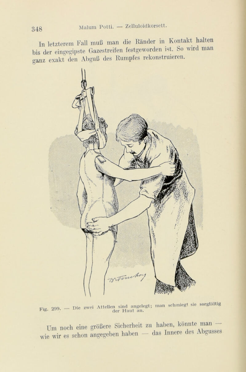 In letzterem Fall muB man die Rander in Kontakt halten bis der eingegipste Gazestreifen festgeworden ist. So wird man ganz exakt den AbguB des Rumpfes rekonstruieren. Fig. 299. — Die zwei Attellen sind angelegt; der Haut an. man sehmiegt sie sorgtaltig Um noch eine grôBcrc Sicherheit zu wie wir es schon angegeben haben Indien, konnte man das Innere des Abgusses