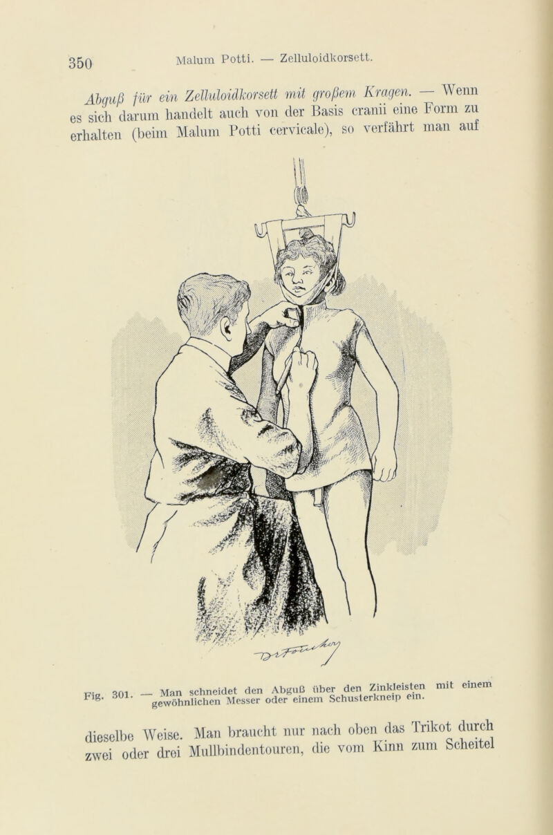 ÂbquB fur ein Zelluloidkorsett mit grofkm Kragen. — Wenn es sich darum handelt auch von der Basis cranii eme Form zu erhalten (beim Malum Potti cervicale), so verfâhrt man auf Fig. 301. - Man schncidet den AbguG über den Zinkleisten mit einem sewôhnlichen Messer oder einem Schusterkneip em. dieselbe Weise. Man braueht nur nach oben (las Tnkot clurch zwei oder droi Mullbindentourcn, die vom Kinn zura Scheitel