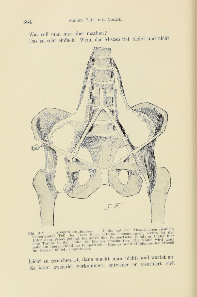 Was soll man nun aber machen? Das ist sehr einfach. Wenn der AbszeB tief bleibt und nicht . links liai der AbszeB einen ziemlich Fig. 319. — Kiliaca interna eingenommen; rechts ist der bedeutenden I eil < . / r <ias poupartsche Band; er bildet hier Filer dem Psoas geft1.*1 s 'uiïinen Trochanters. Die Nadel wird ganz nahe am<otH;ren Bandes in die HAhle, die der AbszeB irn Becken bildet, eingestoBen. leicht zu erreichen ist, dann macht man nichts und wartct ab_ Es kann zweierlei vorkommen: entweder er resorbiert su h