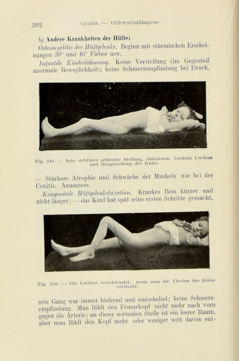 b) Amlcre Krankheiten der lliiïtc: Osteomyelitis des Hüftgelenks, Beginn mit stüimischen Eischei- nungen 39° und 40° Fieber usw L 1 1. ^ Vy 1-1 ^ v 1 v Infantile Kinderlàhmung. Reine Versteifung (im Gegenteil anormale Bcweglichkeit), keine Schmerzempfindung bei Druck. Fig. 349. — Sehr sichtbare und schlechte Stellung, Abduktion, lumbale Lordose Beusestellung des Knies. Stàrkere Atrophie und Schwâche der Muskeln wie b(i der Coxitis. Anamnese. Konqenitale Hüftgelenksluxation. Krankes Hein kiirzer und nicht langer; — das Kind liât spât seine ersten Schritte gemaeht, Fig. 350. — Die Lordose verschwindet, wenn verstarkt. nian die Flexion des Knies sein Gang war immer hinkend und watschelnd; keine Schmerz- empfindung. Man fühlt den Femurkopf nicht mehr nacli vorn frerren die Arterie; an dieser normalcn Stelle ist em leerer Raum, aber man fühlt den Kopf mehr oder wcniger weit davon eut-