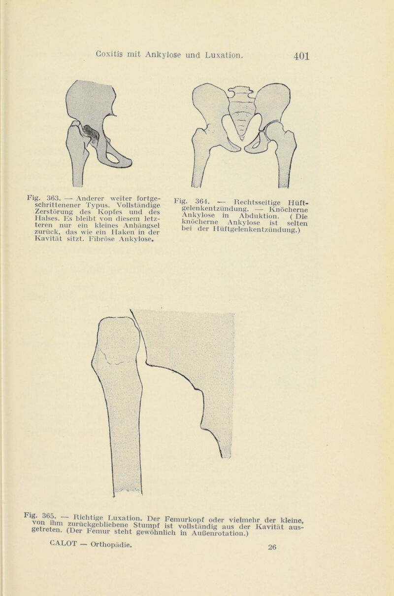 Fig. 363. — Anderer weiter fortge- schrittenener Typus. Yollstândige Zerstôrung des Kopfes und des Ilalses. Es bleibt von diesem letz- teren nur ein kleines Anhângsel zurück, das wie ein Ha ken in der Kavitàt sitzt. Fibrose Ankylosé. Fig. 364. -— Reclitsseitige Hüft- gelenkentzündung. — Knôcherne Ankylosé in Abduktion. ( Die knôcherne Ankylosé ist selten bei der Hüftgelenkentzündung.) ^3«L j ' fc^ tige l.uxation. Der Femurkopf oder vielmehr der kleine, eelreipn 'ruc|î,§el)Lebene Stumpf ist vollstandig aus der Kavitat aus- geireten. (Der Fémur steht gewôhnlicli in Au(3enrotation.) CALOT — Orthopâdie. 26