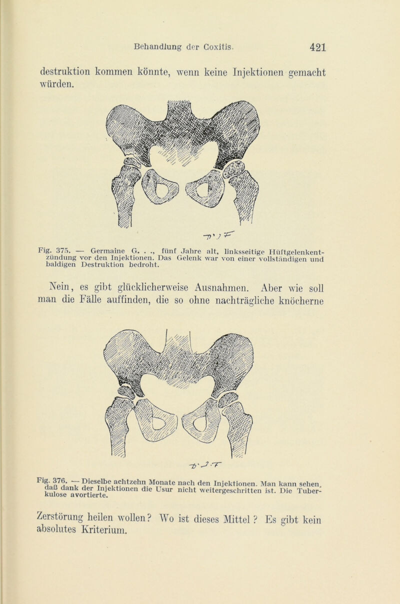 destruktion kommen kônnte, wenn keine Injektionen gemacht würden. -7 Fig. 375. — Germaine G. . fünf Jahre ait, linksseitige Hüftgelenkent- zündung vor den Injektionen. Das Gelenk war von einer vollstandigen und baldigen Destruktion bedroht. Nein, es gibt glücklicherweise Ausnahmen. Aber wie soll man die Fàlle auffinden, die so ohne nachtrâgliche knocherne -7y-J-'r T achtzehn Monate nacli den Injektionen. Man kann sehen daü dank der Injektionen die Usur nicht weitergeschritten ist. Die Tuber- kulose avortierte. Zerstorung heilen wollen? Wo ist dieses Mittel ? Es gibt kein absolûtes Kriterium.