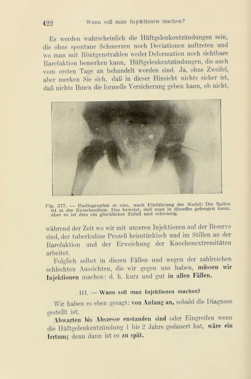 Wann soll man Injektionen machen? Es werden wahrscheinlich die Hüftgelenkentzündungen sein, die ohne spontané Schmerzen noch Deviationen auftreten und wo man mit Rôntgenstrahlcn weder Deformation noch sichtbare Rarefaktion bemerken kann, Hüftgelenkentzündungen, die auch vom ersten Tâge an behandelt worden sind. Ja, ohne Zweifel, aber merken Sie sich, daB in dieser Hinsicht nichts sicher ist, daB nichts Ihnen die formelle Versicherung geben kann, ob nicht, Fig. 377. — Radiographie in vivo, nach Einführung der Nadel: Die Spitze ist in der Zwischcnlinie. Das beweist, daB man in diesclbe gelangen kann, aber es ist dies ein glücklicher Zufall und schwierig. wahrend der Zcit wo wir mit unseren Injektionen auf der Reserve sind, der tuberkulôse ProzeB heimtückisch und im Stillen an der Rarefaktion und der Erweichung der Knochenextremitaten arbeitet. Folglich selbst in diesen Fallen und wegen der zahlreichen schlechten Aussichten, die wir gegen uns haben, müssen wir Injektionen machen: d. h. kurz und gut in allen Fallen. III — Wann soll man Injektionen machen? Wir haben es eben gesagt: von Anïangan, sobald die Diagnose gestellt ist. Abwarten bis Abszesse enstanden sind odcr Eingreifen wenn die Hüftgelenkentzündung 1 bis 2 Jahre gedauert liât, ware ein Irrtum; denn dann ist es zu spât.