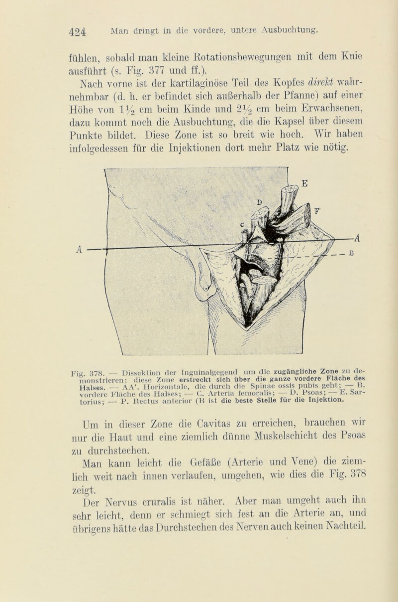 fiihlen, sobald man kleine Kotationsbewegungen mit dem Knie ausfiihrt (s. Fig. 377 und ff.). Nach vorne ist der kartilaginôse Teil des Kopfes direkt wahr- nehmbar (d. h. er befindet sich auBerhalb der Pfanne) auf einer Hohe von 1 y2 cm beim Kinde und 2y2 cm beim Erwachsenen, dazu kommt noch die Ausbuchtung, die die Kapsel über diesem Pnnkte bildet. Diese Zone ist so breit wie hoch. Wir haben infolgedessen für die Injektionen dort mehr Platz wie notig. A I'ig. 378. — Dissektion der Inguinalgegend um die zugàngliche Zone zu de- monstrieren : diese Zone erstreckt sich über die ganze vordere Flàche des Halses. — AA’. Horizontale, die durch die Spinae ossis pubis geht; • B. vordere Floche des Plaises; — C. Arteria femoralis; H. Psoas; F. Sai- torius; — p. Rectus anterior (B ist die beste Stelle für die Injektion. Um in dieser Zone die Cavitas zu erreichen, brauchen wir nur die Haut und eine ziemlich dünne Muskelschicht des Psoas zu durchstechen. Man kann leicht die GefaBe (Arterie und Yene) die ziem- lich weit nach innen verlaufen, umgehen, wie dies die Fig. 378 zeigt. Der Ncrvus cruralis ist nâher. Aber man umgeht auch ilm sehr leicht, denn er schmiegt sicli fest an die Arterie an, und übrigens hatte das Durchstechen des Nerven auch keinen Nachteil.