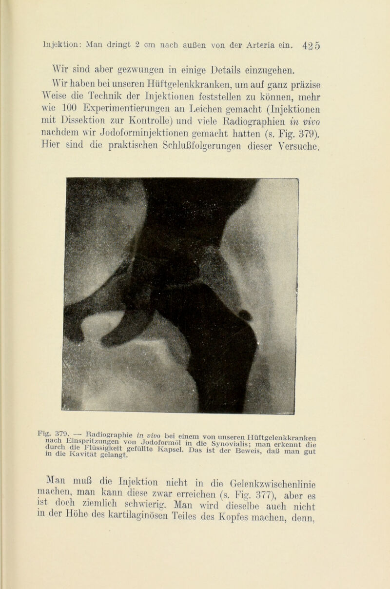 AVir sind aber gezwnngen in einige Details einzugehen. Wir haben bei unseren Hiiftgelenkkranken, um auf ganz prâzise Weise die Technik der Injektionen feststellen zu konnen, mehr wie 100 Experimentierungen an Leichen gemacht (Injektionen mit Dissektion znr Kontrolle) nnd viele Radiographien in vivo nachdem wir Jodoforminjektionen gemacht hatten (s. Fig. 379). Hier sind die praktischen SchluBfolgerungen dieser Versuche. FinoPi79r- Radiographie in vivo bei einem von unseren Hüîtgelenkkranken durcli1 cîjeS FS 3^Tfftd0f?rmô,I in die Synovialis; man erkennt die ?n dïe ÈÆSSl.g#,Unte KapSeL DaS ist der Beweis’ d*« ™>n gut Man mu B die lnjektion nicht in die Gelenkzwischenlinie machen, man kann dièse zwar erreichen (s. Fig. 377), aber es ist doch ziemlich schwierig. Man wird dieselbe auch nicht m der Holie des kartilaginosen Teiles des Kopfes machen, denn.