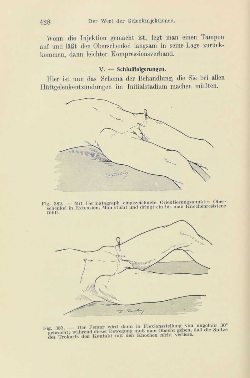 Wenn die Injektion gemacht ist, legt man einen Tampon auf und làBt den Oberschenkel langsam in seine Lage zurück- kommen, dann leichter Kompressionsverband. V. — SchluRfolgerungen. Hier ist nun das Schéma der Behandlung, die Sie bei allen Hüftgelenkentziindungen im Initialstadium maclien müBten. Fiiï 389 Mit Dermatograph eingezeichnete Orientierungspunkte: Ober- schenkel in Extension. Man sticht und dringt ein bis man Knochenresistenz fühlt. Fis 3K3 Der Fémur wird dann in Flexionsstellung von ungcfahr 30 eêbracht* wàhrend dieser Bewegung mufi man Obacht geben, daB die Spitze des Trokarts den Kontakt mit den Knochen nicht verliere.