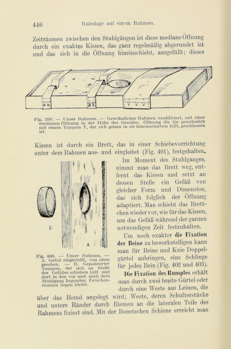 Zeitràumen zwischen den Stuhlgângen ist diese médiane ôffnung dur ch ein exaktes Kissen, das ganz regelmâBig abgerundet ist und das sicli in die Offnung hineinschiebt, ausgefüllt; dieses pjo 399 Unser Rahmen. — Gewôhnlicher Rahmen modifiziert, mit einer medianen Offnung in der Hôhe des GesaBes. Offnung die fiir gewohnlich mit einem Tampon T, der sich genau in sie hineinschieben làfît, geschlossen ist. Kissen ist durch ein Brett, das in einer Schiebevorrichtung unter dem Rahmen ans- und cingleitet (Fig. 401), festgehalten. Fig. 400. — Unser Rahmen. — A. GefaB eingestellt, von oben gesehen. — B. Gepolsterter Tampon, der sich an Stelle des GefaBes schieben laBt und dort in den vor und nach dem Stuhlgang liegenden Zwischen- ràumen liegen bleibt. Im Moment des Stuhlganges, nimmt man das Brett weg, ent- fernt das Kissen und setzt an dessen Stelle ein GefaB von gleicher Form und Dimension, das sich folglich der Offnung adaptiert. Man schiebt das Brett- chen wieder vor, wie fiir das Kissen, um das GefaB wahrend der ganzen notwendigen Zeit festzuhalten. Um noch exakter die Fixation der Reine zu bewerkstelligen kann man fiir Beinc und Knie Doppel- gürtel anbringen, eine Schlinge für jedes Bein (Fig. 402 und 403). Die Fixation desUumpfes erhalt man durch zwei breite ( »lirtel oder durch eine Weste aus Leinen, die über das Hemd angelegt wird; Weste, deren Schulterstiicke und untere Rânder durch Riemen an die lateralen Telle des Rahmens fixiert sind. Mit der Bonetschen Schiene erreicht man