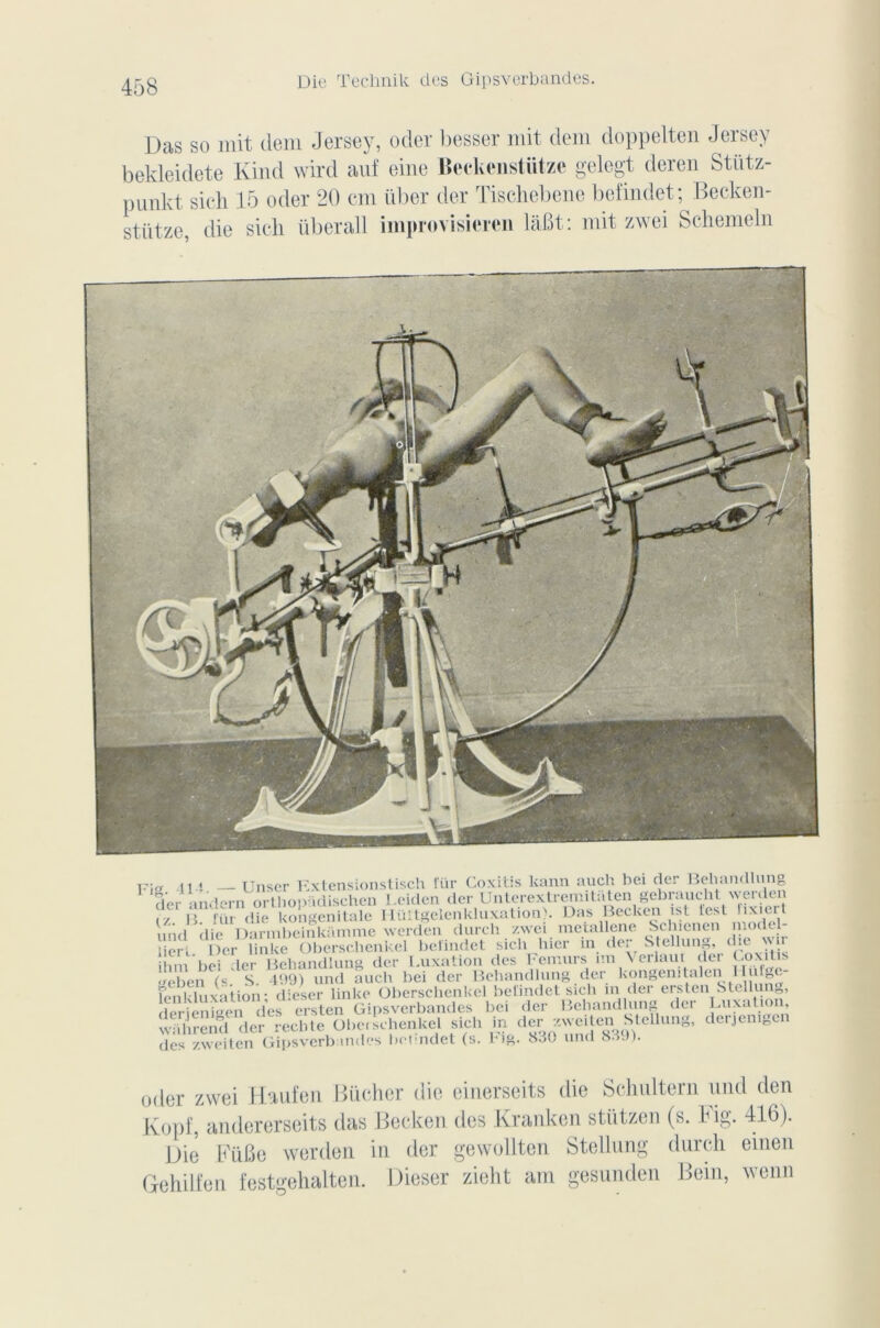Das so mit dem Jersey, oder besser mit clem doppelten Jersey bekleidete Kind wird auf eine Beckenstiitzc g cle&t derei S punkt sieh 15 oder 20 cm über der Tischebene befindet; Becken- stütze, die sich überall improvisieren laBt: mit zwei Schemeln Fi„ 41.J Unser Extensionstisch für Coxitis kann auch bei der Behandlung der andern orthopadischen Leiden der Unterextremitaten gebraucbt werden (/. B. für die kongenitale Iiüitgelenkluxation). Das Becken ist lest lixiert uiid die Darmbeinkamme werden durch zwei metallene Schienen >«odcl- üeri. Der linke Oberscbenkel befindet sich hier m der Stellun„, die w r ilmi bei der Behandlung der Luxation des Fémurs im \erlaui der Loxit <>eben (« S 499) und auch bei der Behandlung der kongenrtalen llutge- feni uvition- dieser linke Oberschenkel befindet sich in der ersten btellung, rieriSeï des ersten Gipsverbandes bei der Behandlung der Luxation, wihrcnd der rechte Olierschenkel sich in der zweiten Stellung, deijenigcn des^zw^tOT*Gipsverban11 es bedndet (s. Fig. 830 und 839). oder zwei Kopf, ant Die Fii Gehilfen Haufen Bûcher die einerseits die Schultern und den ererseits das Becken des Kranken stützen (s. h ig. 416). Pu> werden in der gewollten Stellung durch einen o-ehalten. Dieser zieht am gesunden Bein, wenn O