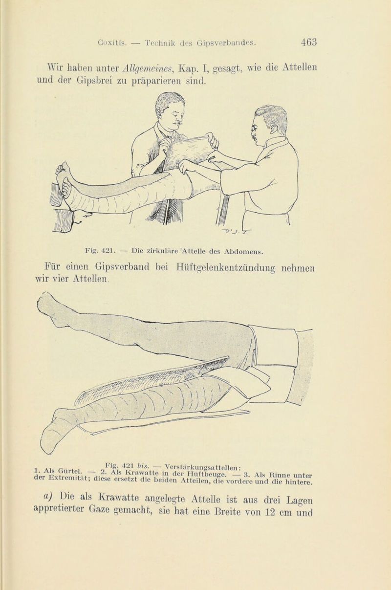 Wir haben unter Allgemeines, Kap. I, gesagt. wie die Attellen und der Gipsbrei zu prâparieren sind. Fig. 421. — Die zirkulare Attelle des Abdomens. Für einen Gipsverband bei Hüftgelenkentzündung nehmen wir vier Attellen. 1. Als Gürtel. der Extremitiit 421 bis. —Verstarkungsattellen : Als Krawatte in der Hüftbeuge. — 3. Als Rinne nnter diese ersetzt die beiden Atteilen, die vordere und die hintere. a) Die als Krawatte angelegte Attelle ist ans drei Lagen appretierter Gaze gemacht, sie hat eine Breite von 12 cm und