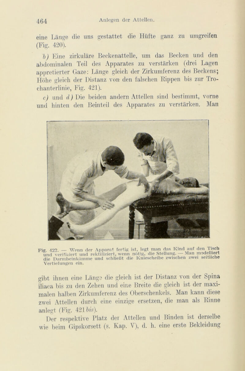 eine Lange die uns gestattet die Hüfte ganz zu umgreifen (Fig. 420). b) Eine zirknlàre Beckenattelle, nm das Becken nnd den abdominalen Teil des Apparates zu verstârken (drei Lagen appretierter Gaze: Lange gleich der Zirkumferenz des Beckens; Hohe gleich der Distanz von den falschen Rippen bis znr Tro- chanterlinie, Fig. 421). c) nnd d) Die beiden andern Attellen sind bestimmt, vorne und hinten den Beinteil des Apparates zu verstârken. Man FiCT. 422. — Wenn der Apparat fertig ist, Iegt mon das Kind auf den Tisch und verifiziert und rektii'iziert, wenn nôtig, die Stellung. — Man modelhert die Darmbeinkamme und schlieBt die Kniescheibe zwischen zwei seitliclie Vertiefungen ein. gibt ihnen eine Lange die gleich ist der Distanz von der Spina iliaea bis zu den Zehen und eine Breite die gleich ist der maxi- malen halben Zirkumferenz des Oberschenkels. Man kann diese zwei Attellen durch eine einzigc ersetzen, die man als Rinne anlegt (Fig. 421 bis). Der respektive Platz der Attellen und Binden ist derselbe wie beim Gipskorsett (s. Kap. V), d. h. eine erste Bekleidnng