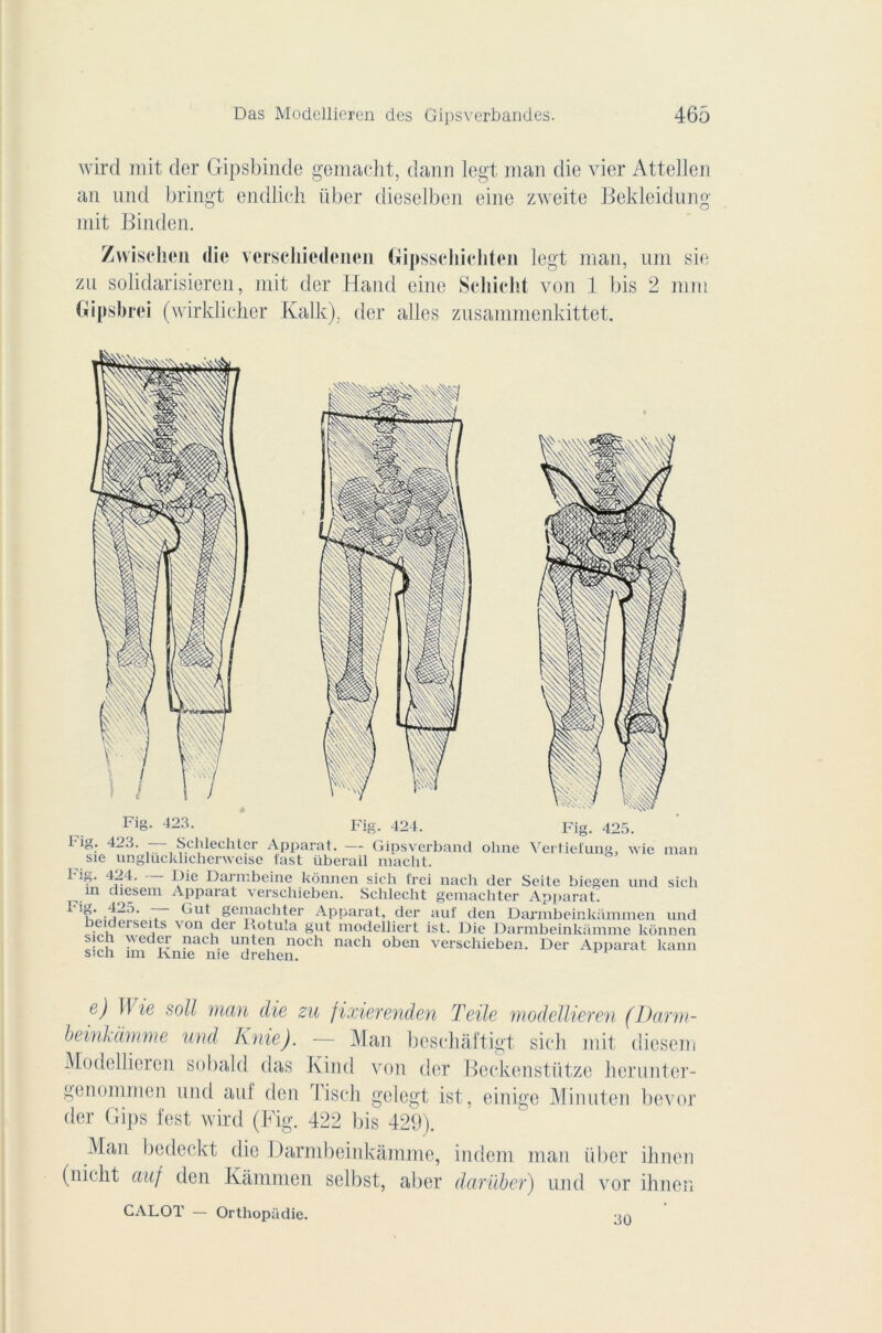 wird mit der Gipsbinde gemacht, dann legt man die vier Attellen an und bringt endlich iiber dieselben eine zweite Bekleidung mit Binden. Zvvisehen die verscliiedenen Gipsschichten legt man, uni sie zu solidarisieren, mit der Hand eine Scliiclit von 1 bis 2 mm Gipsbrei (wirklicher Kalk). der ailes znsammcnkittet. Fig- 424. Fig. 425. i ig- 423. Selilechter Apparat. — Gipsverband ohne Vertiefung, wie man sie unglücklicherweise fast überail macht. ^ 4-4' i,^e Darmbeine kônnen sich frei nach der Seite biegcn und sich in aiesem Apparat verschieben. Schlecht gemachter Apparat. ^ ^11 * gernachter Apparat, der auf den Darmbeinkammen und eicerseits von der Rotma gut modeiliert ist. Die Darmbeinkàmme kônnen sich \vcder nach unten noch nach oben verschieben. Der Apparat kann sich îm Kme me drehen. e) Il ie soit man die zu fixierenden Telle modellieren (Darm- beinkàmme und K nie). — Man beschâftigt sich mit diesem Modellieren sobald das Ivind von der Beckenstütze herunter- genommen und auf den Tisch gelegt ist, einige Minuten bevor der Gips fest wird (Fig. 422 bis 429). Man bodeckt die Darmbeinkàmme, indcm man iiber ihnen (nicht aaf tien Kâmmen selbst, aber darüber) und vor ihnen CALOT — Orthopadie. 30